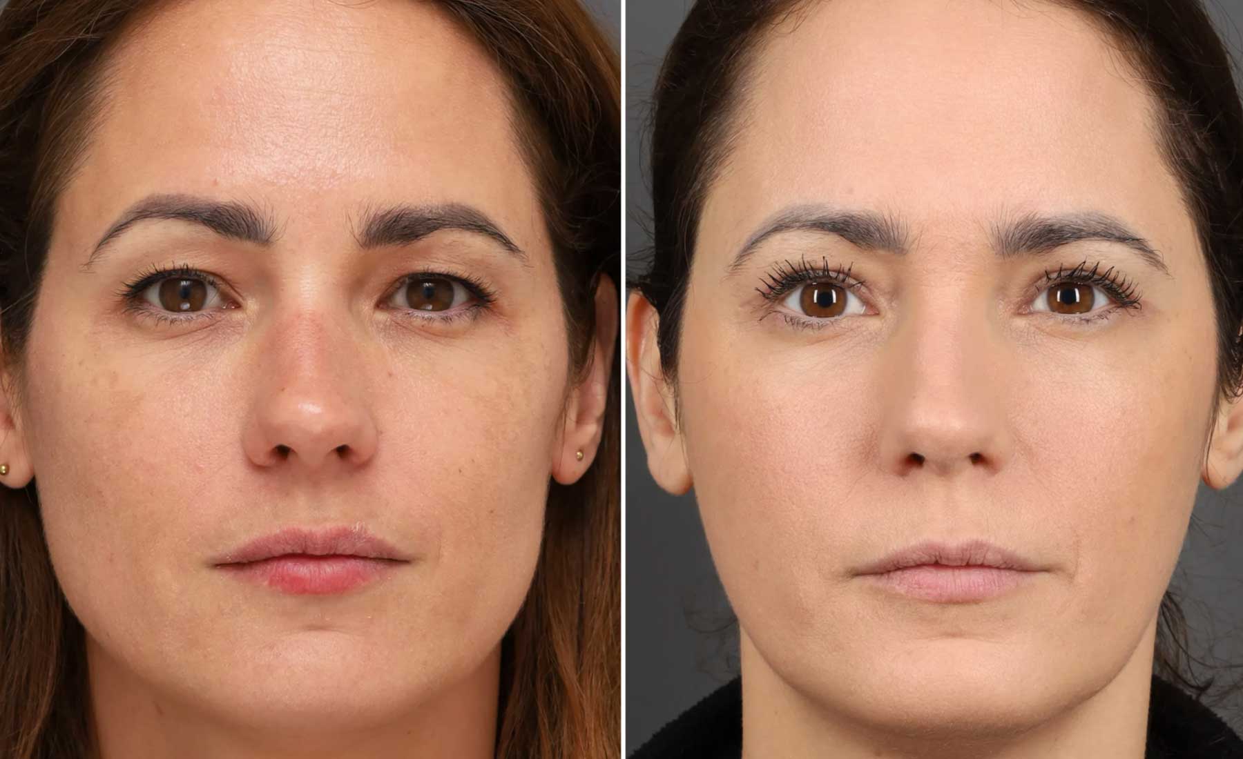 Bruxism Treatment (Teeth Grinding and Jaw Clenching)‎-Before and after