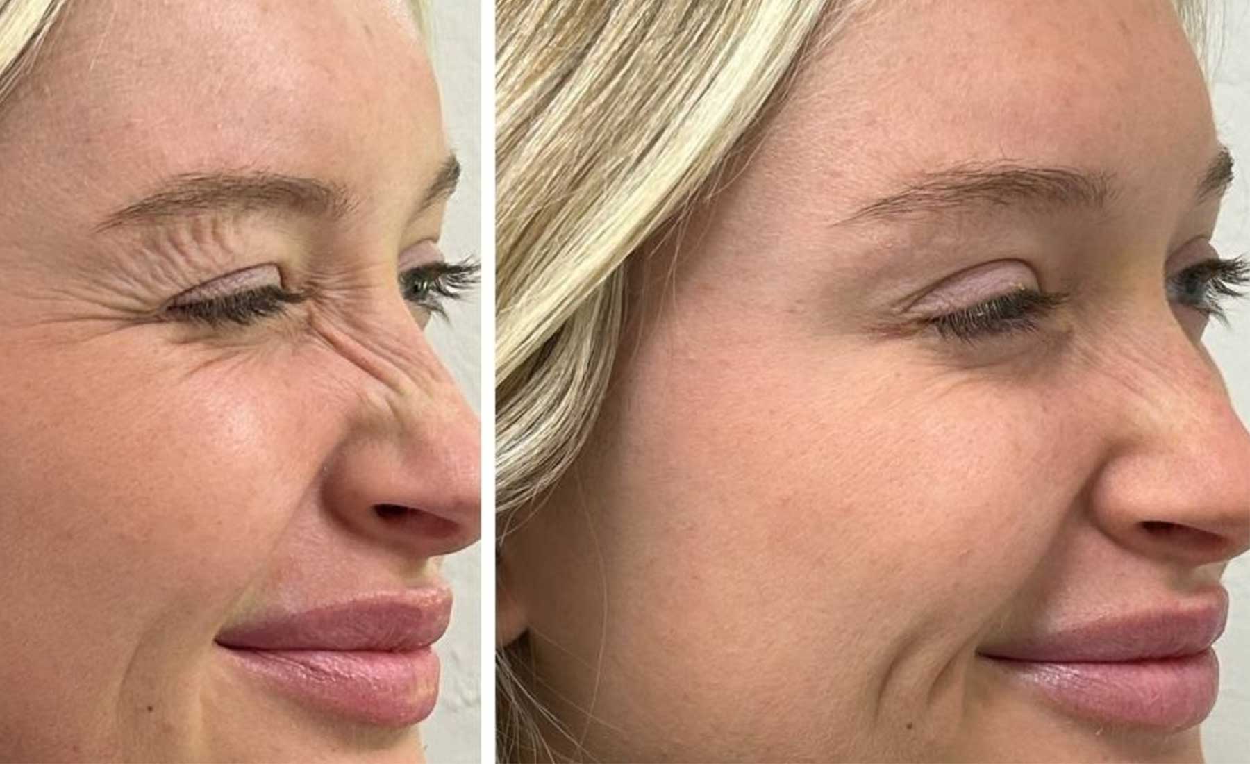 https://monazclinic.com/wp-content/uploads/2024/11/Bunny-Lines-Nose-Wrinkles%E2%80%8E-Before-and-after.jpg