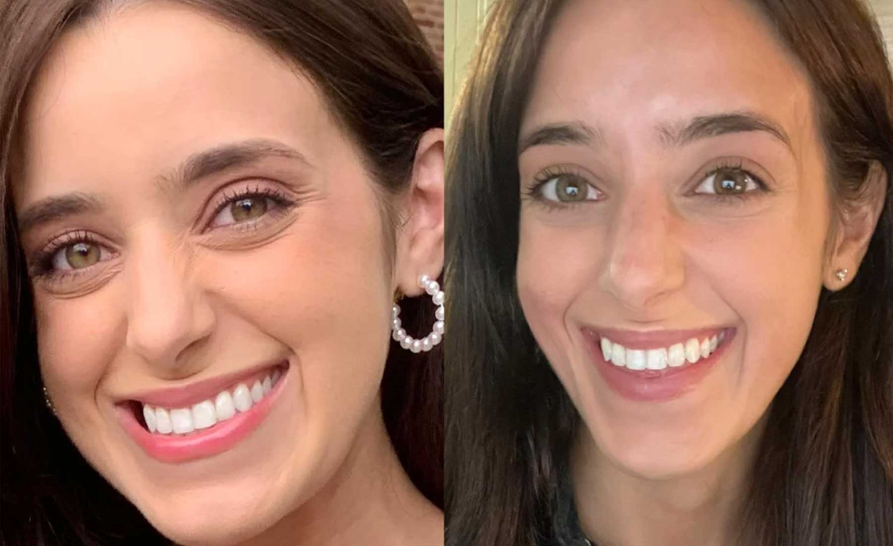 Bunny Lines (Nose Wrinkles)