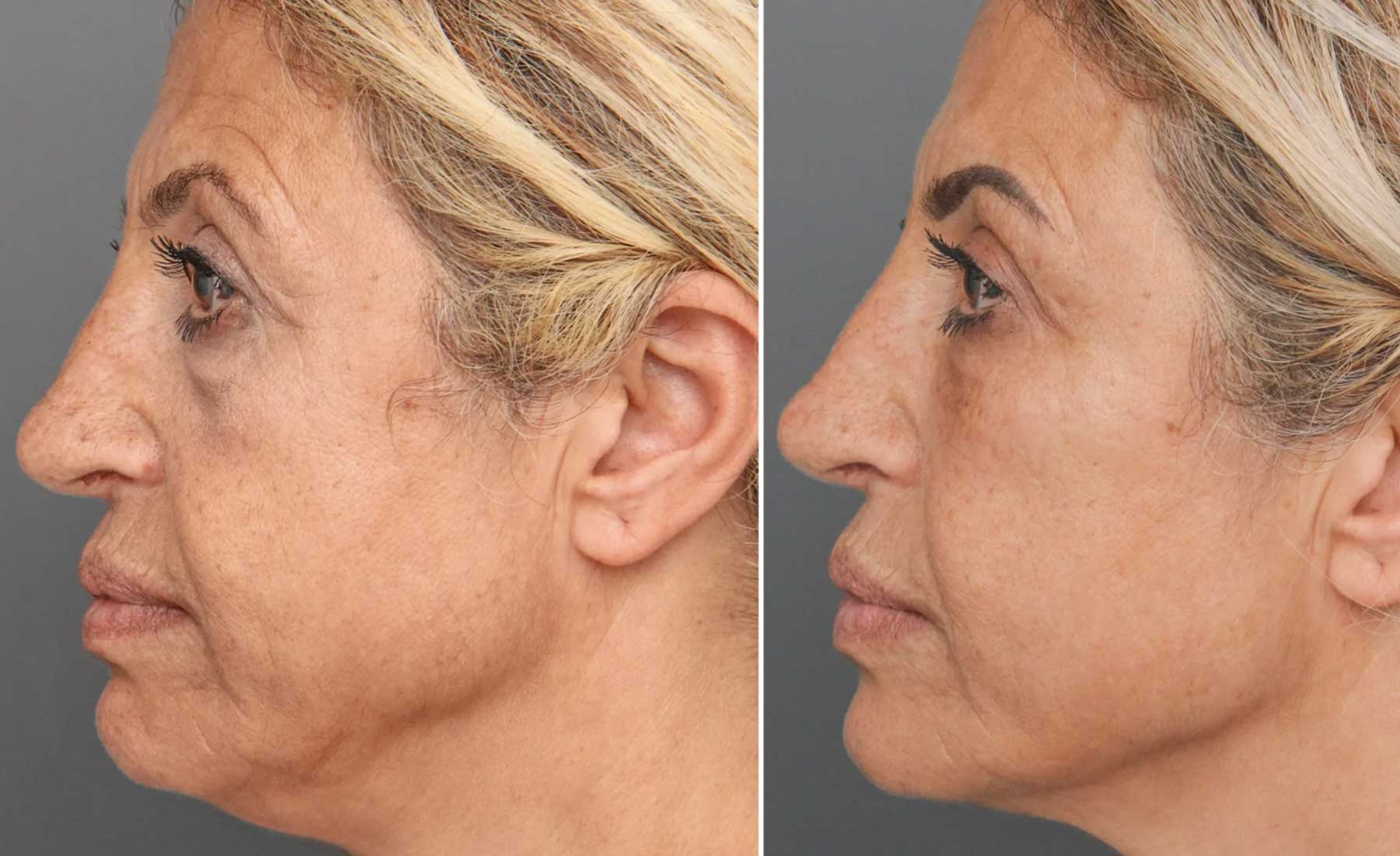 Cheek Enhancement 5 Cheek Enhancement-Before and after