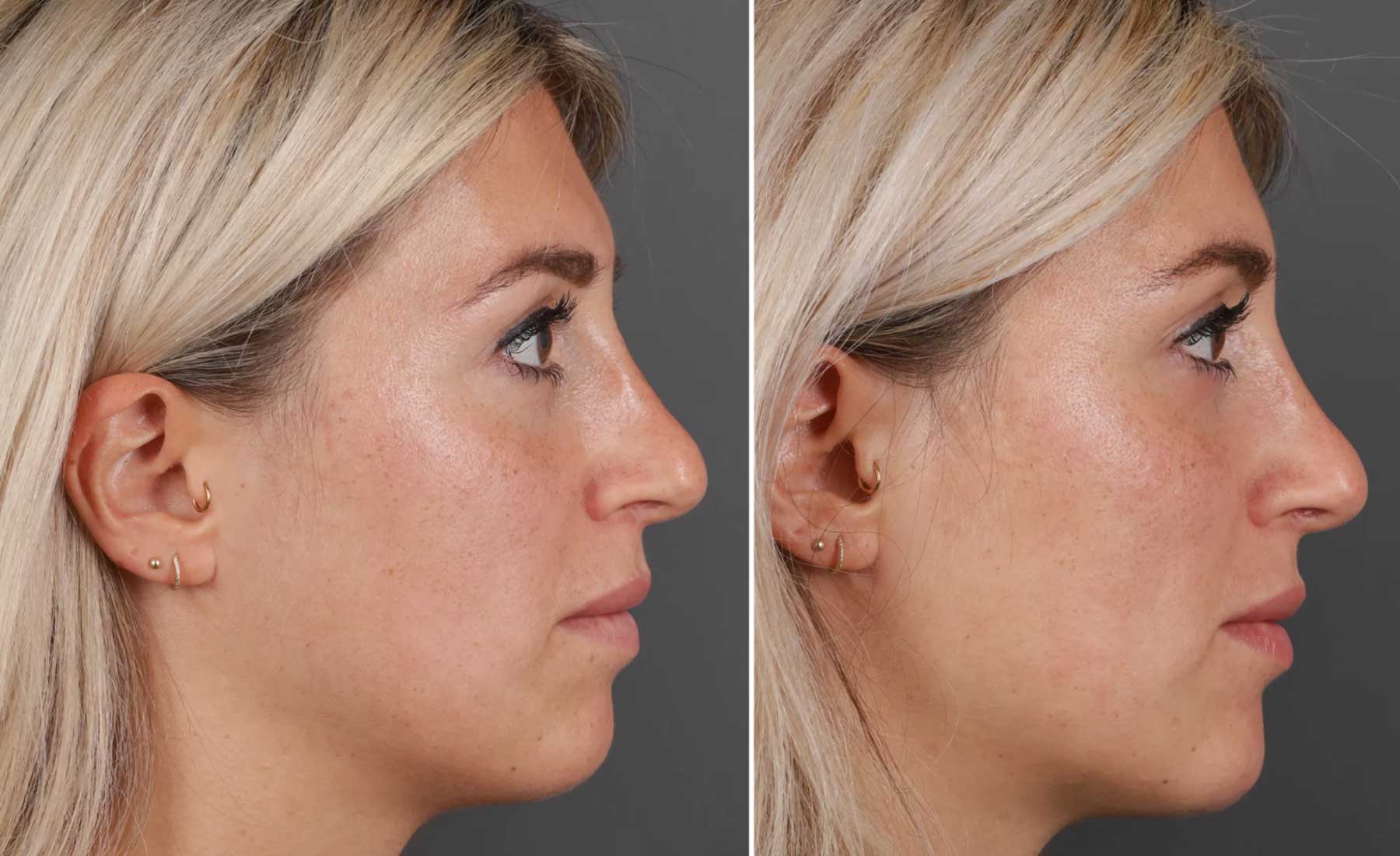 Cheek Enhancement-Before and after