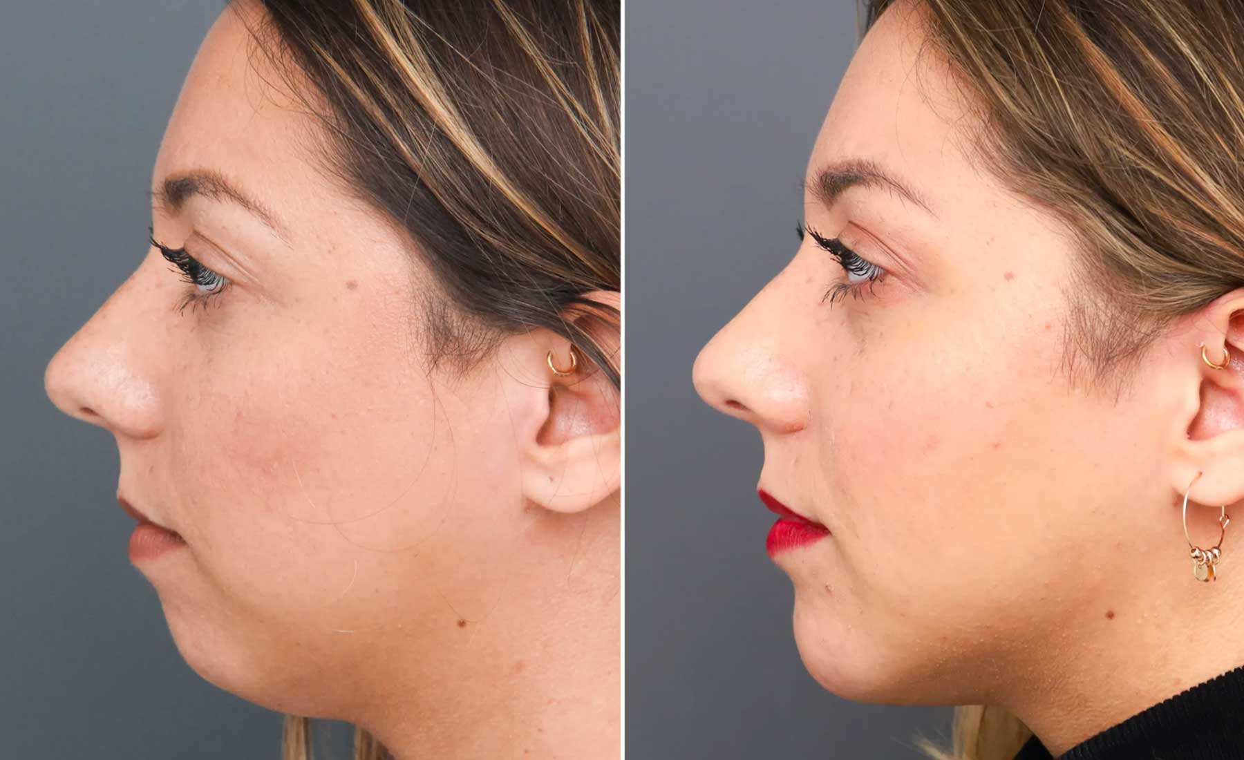 Chin Augmentation 5 Chin Augmentation-Before and after