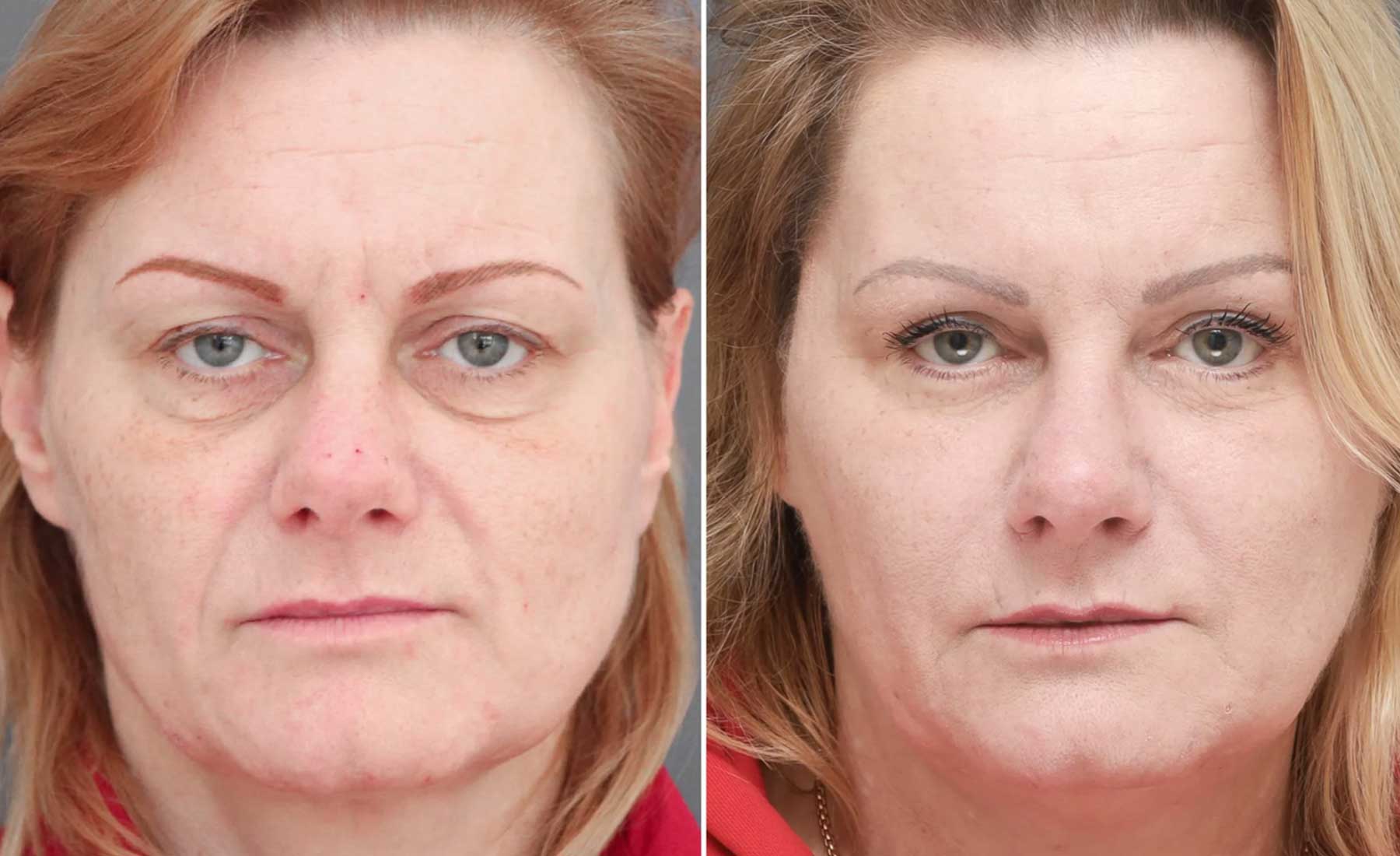 Chin Dimples and Pebbling 5 Chin Dimples and Pebbling-Before and after