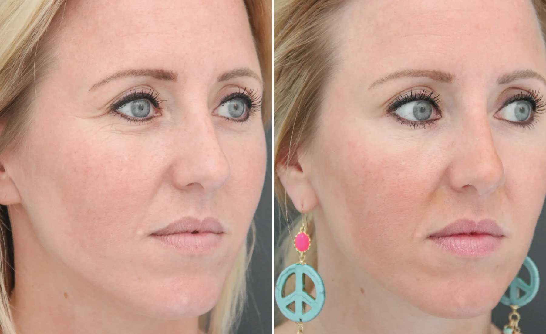 Crow’s Feet (Periorbital Lines)