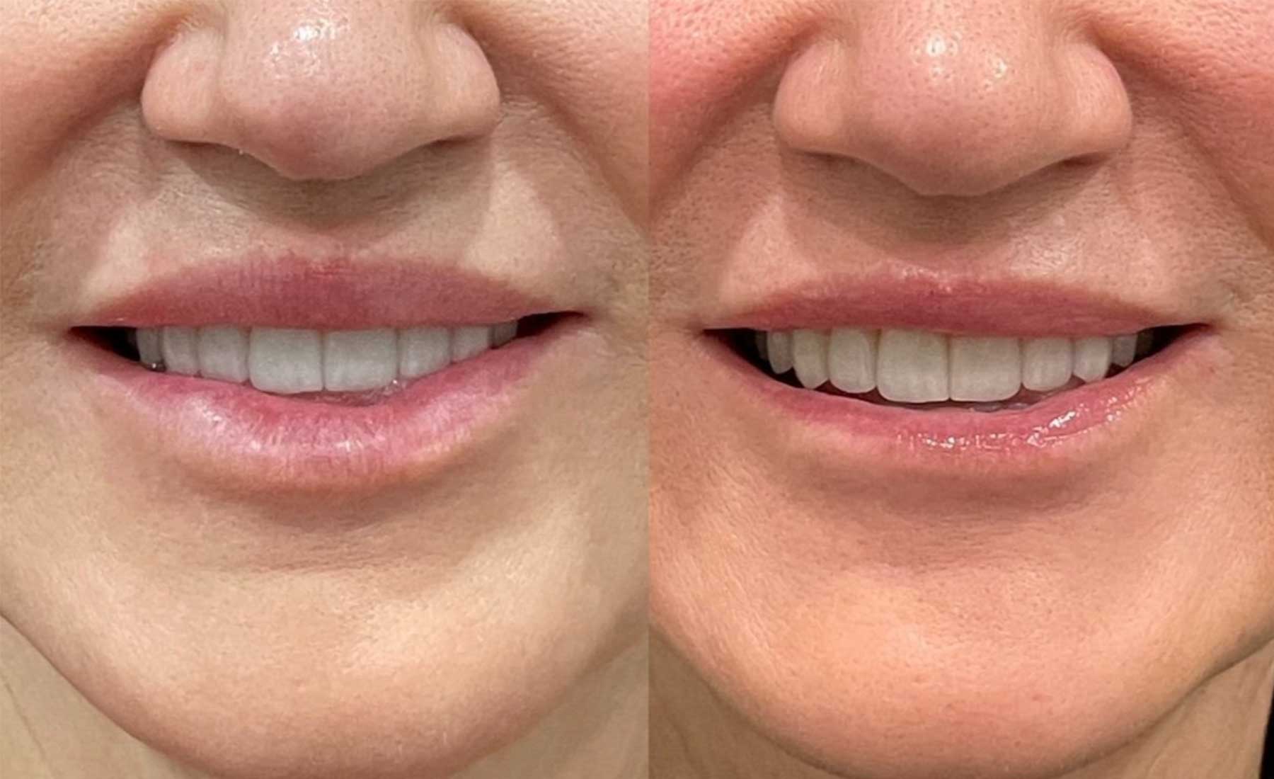 Dermal Filler Dissolving (Hyaluronidase Treatment)