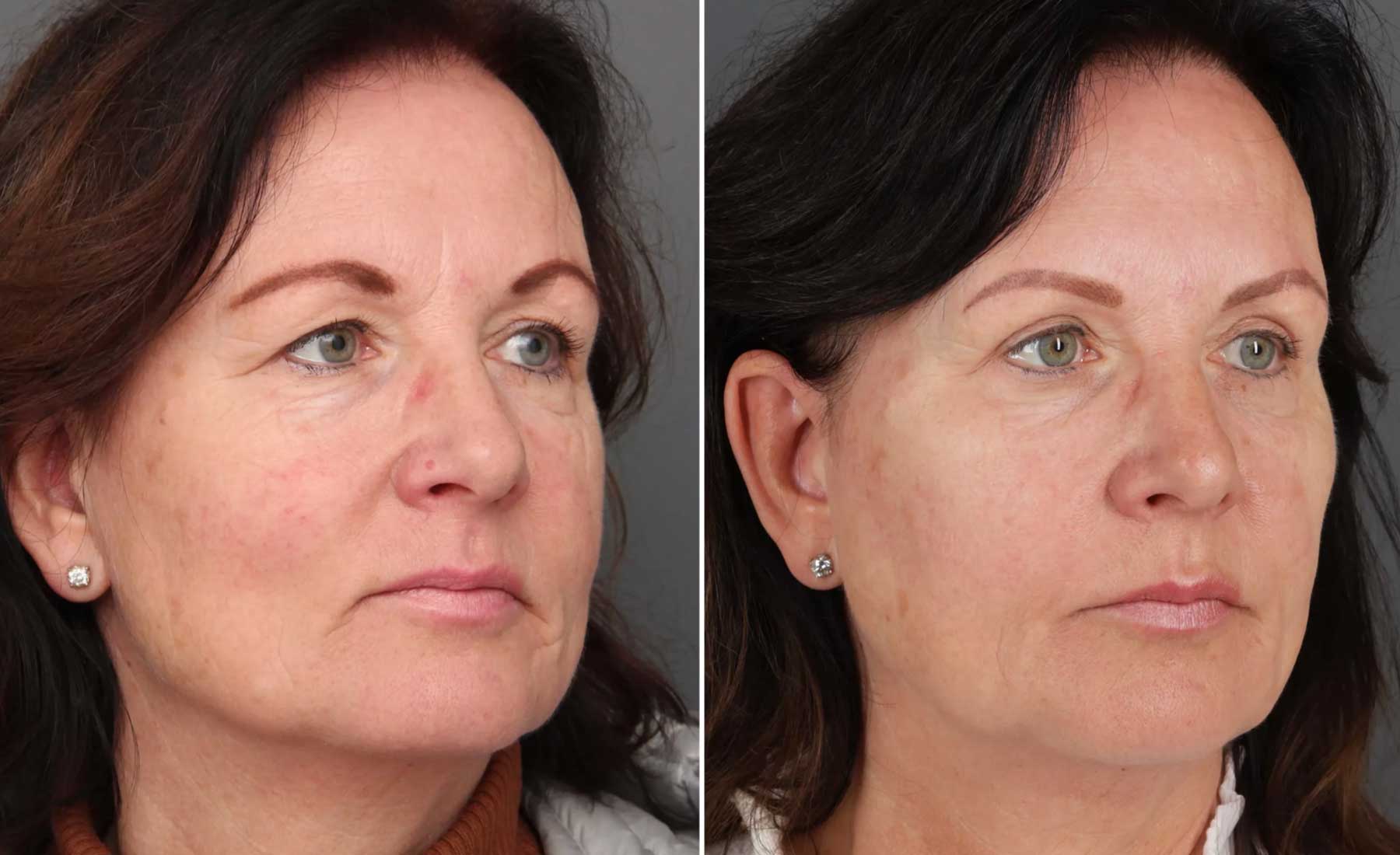 Frown Lines (Glabellar Lines)‎-Before and after