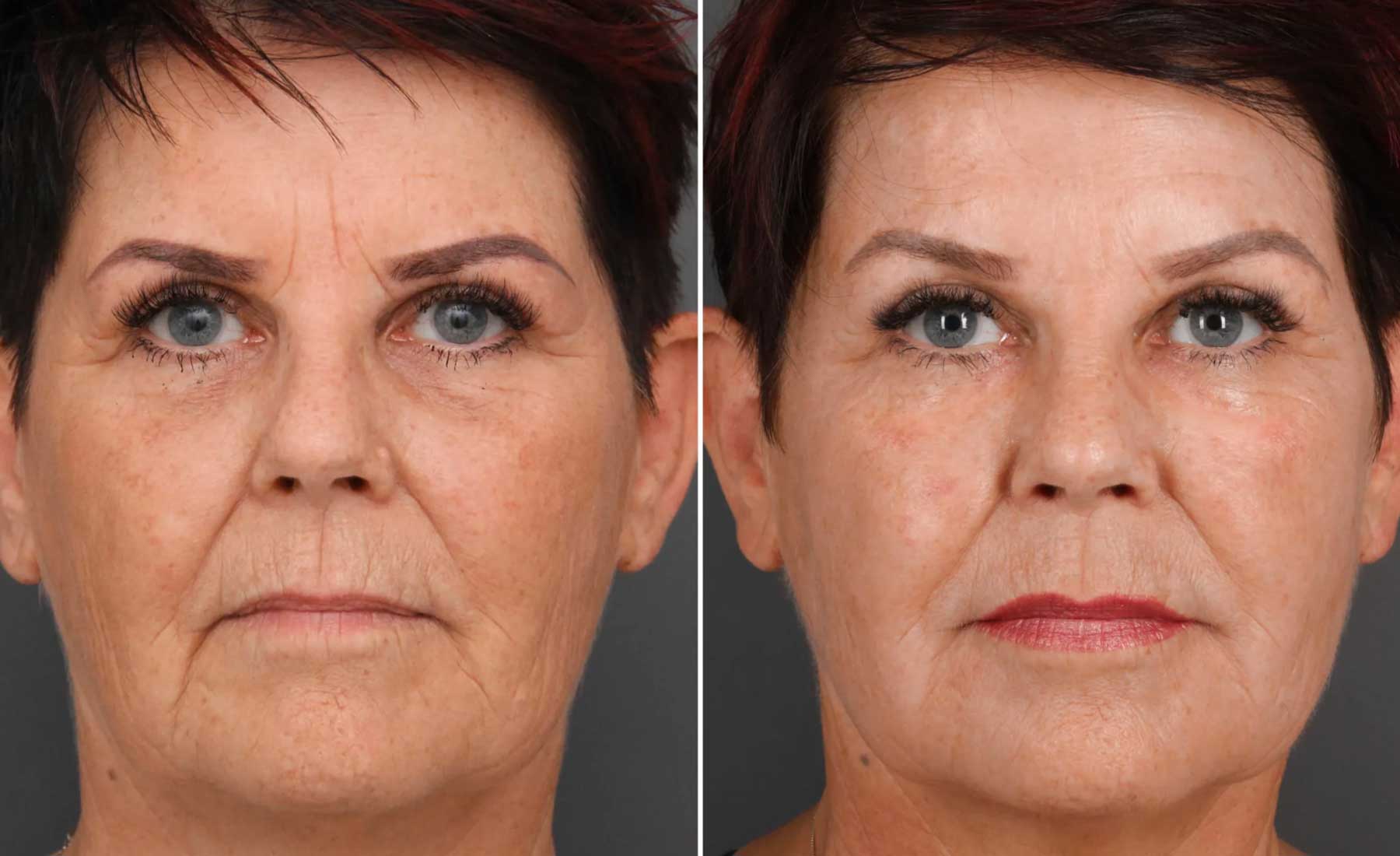 Frown Lines (Glabellar Lines)‎-Before and after