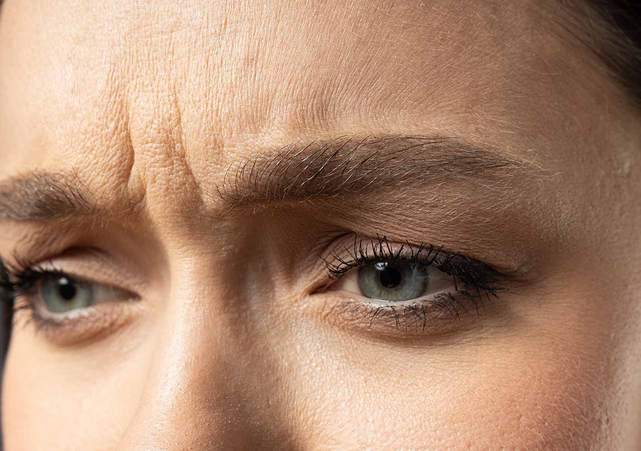 Frown Lines (Glabellar Lines) 1 frown lines close up photo