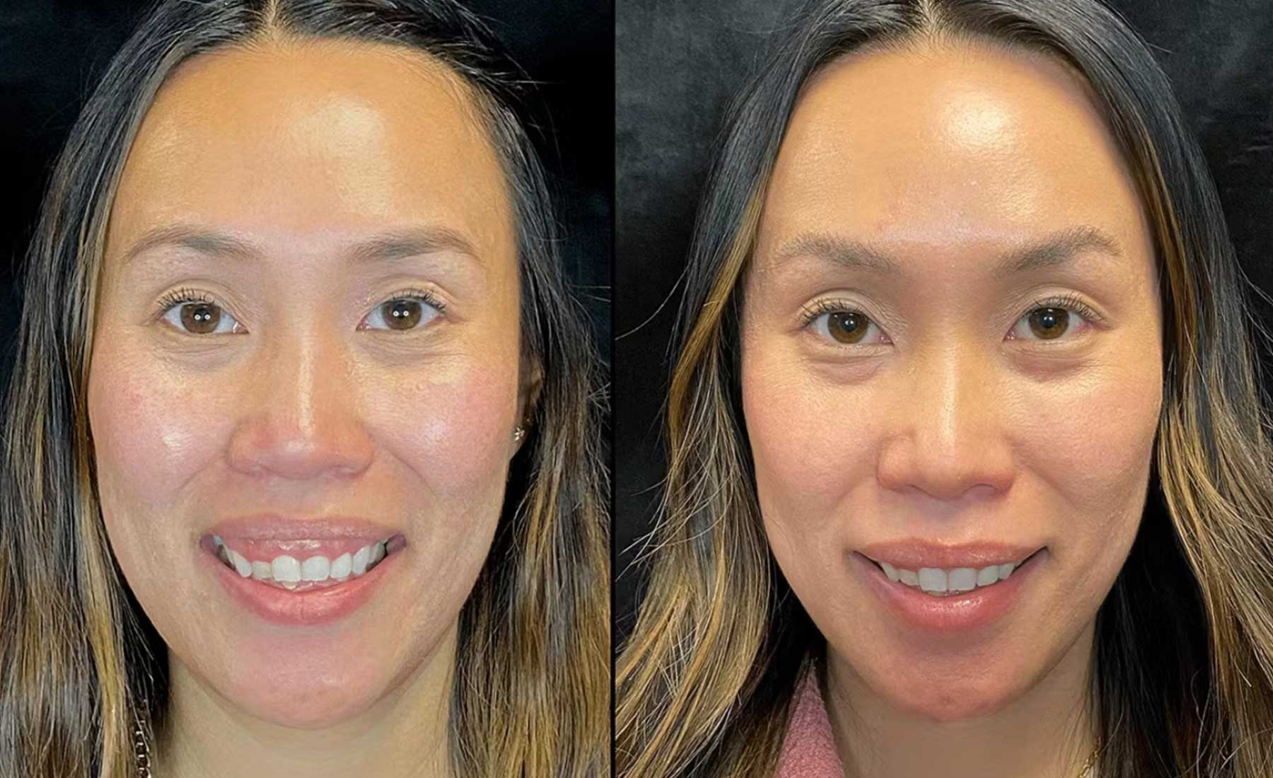 Gummy Smile Correction 4 Gummy Smile Correction-Before and after