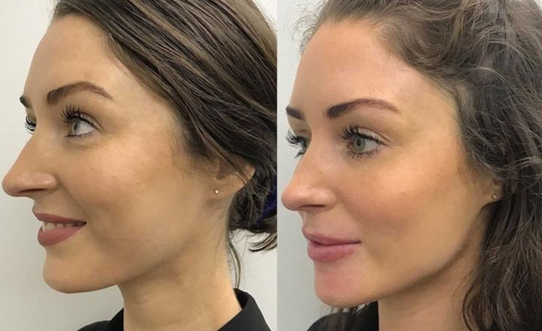 Jawline Contouring 4 Jawline-Countouring-Before-and-after