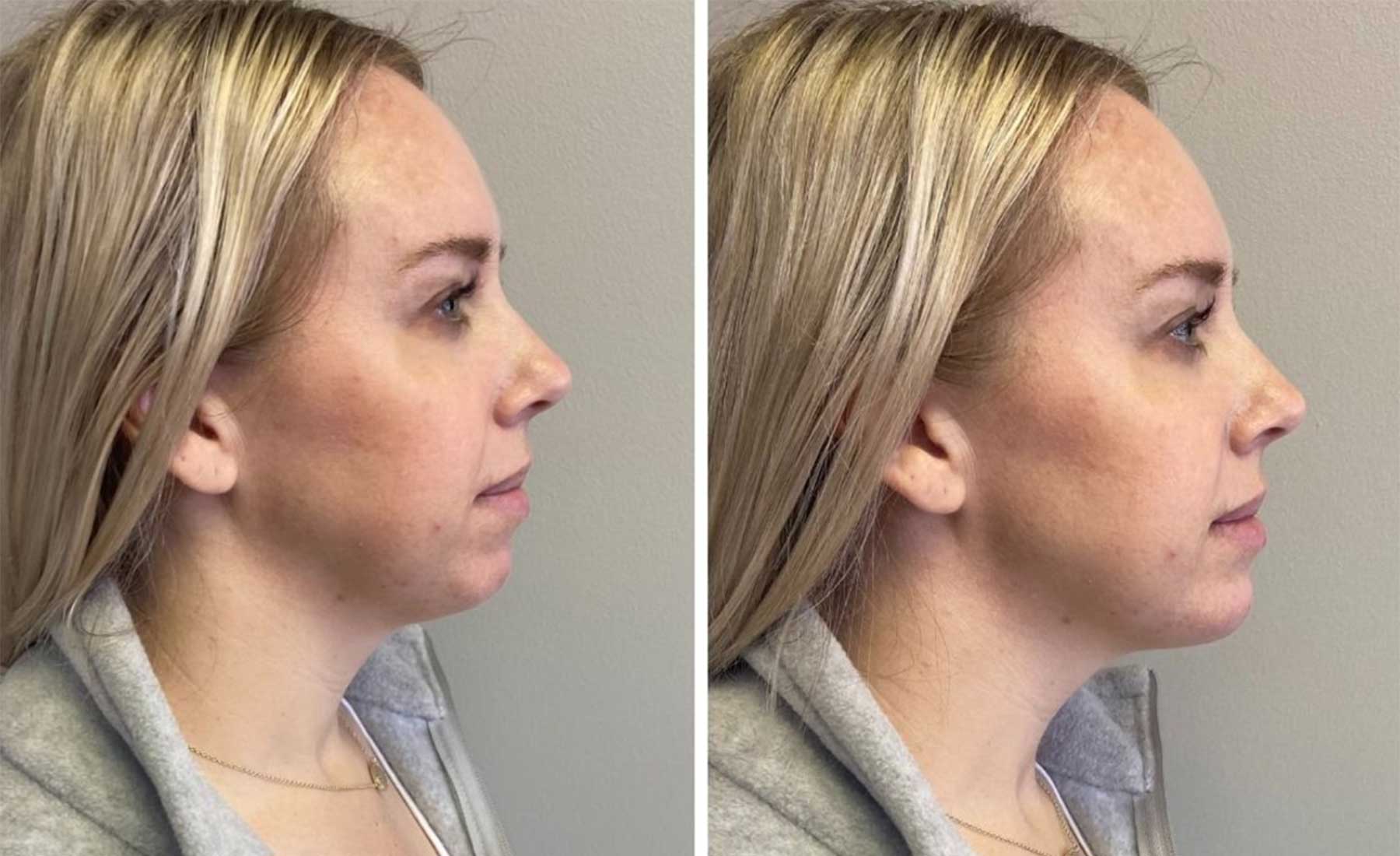 Jawline Countouring-Before and after