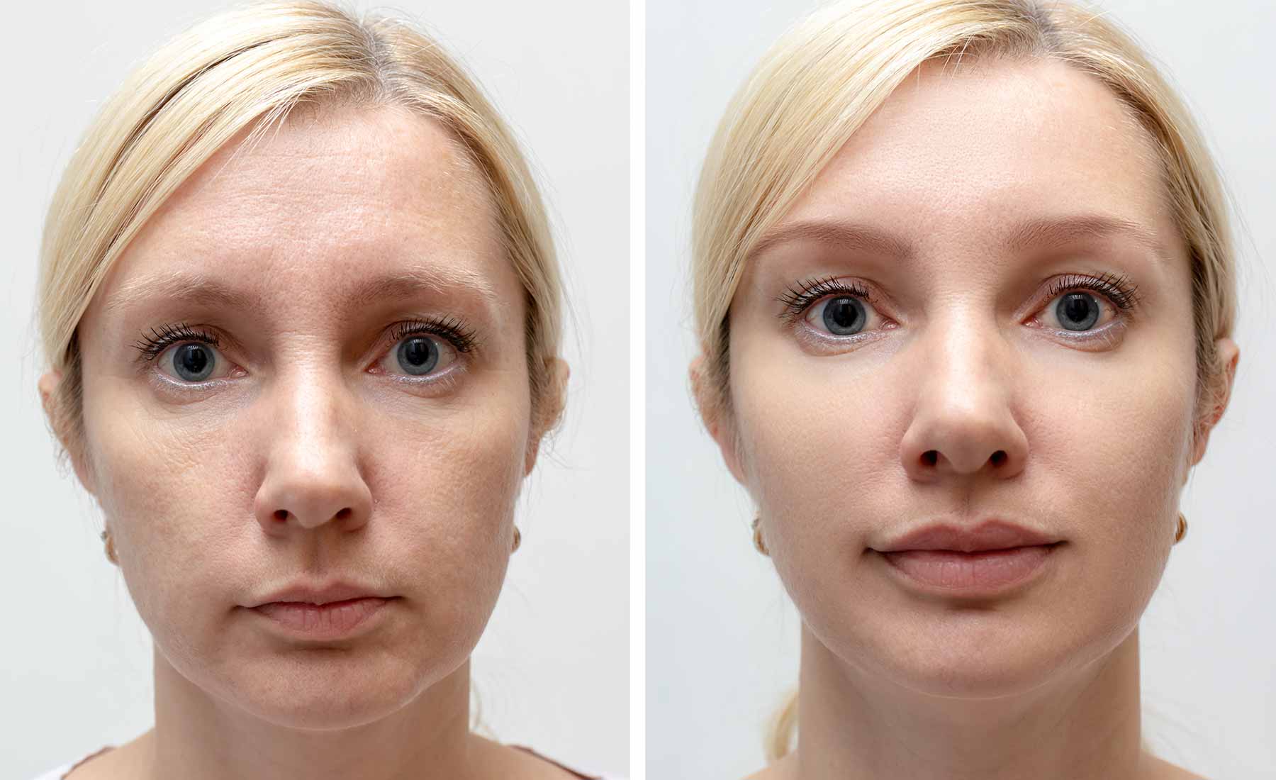 Lip Enhancement 5 Lip-Enhancement-Before-and-After-3