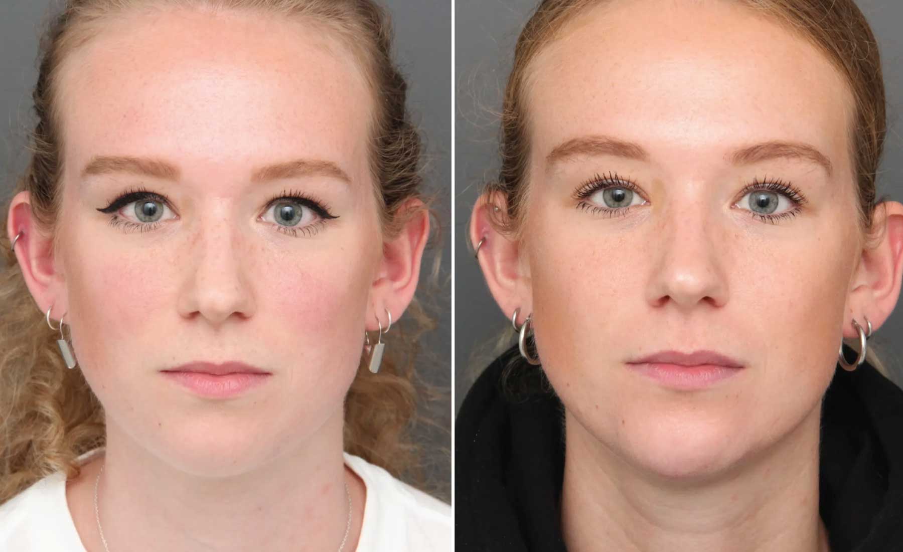 Masseter Reduction (Jaw Slimming)