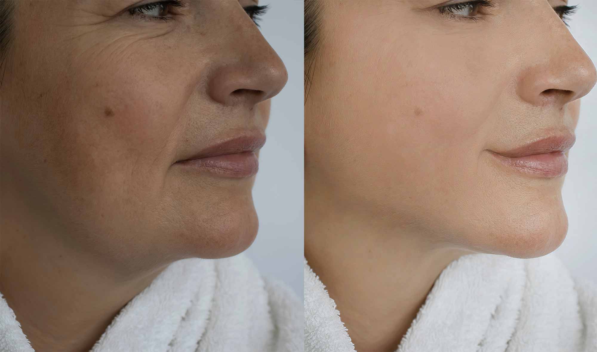 Full Facial Rejuvenation 2 Monaz-clinic-Dermal-Fillers-for-Full-Facial-Rejuvenation