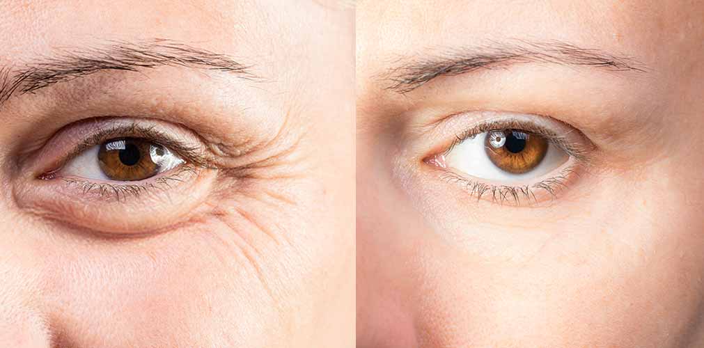Crow's Feet (Periorbital Lines) 3 Monaz clinic crows feet how its work