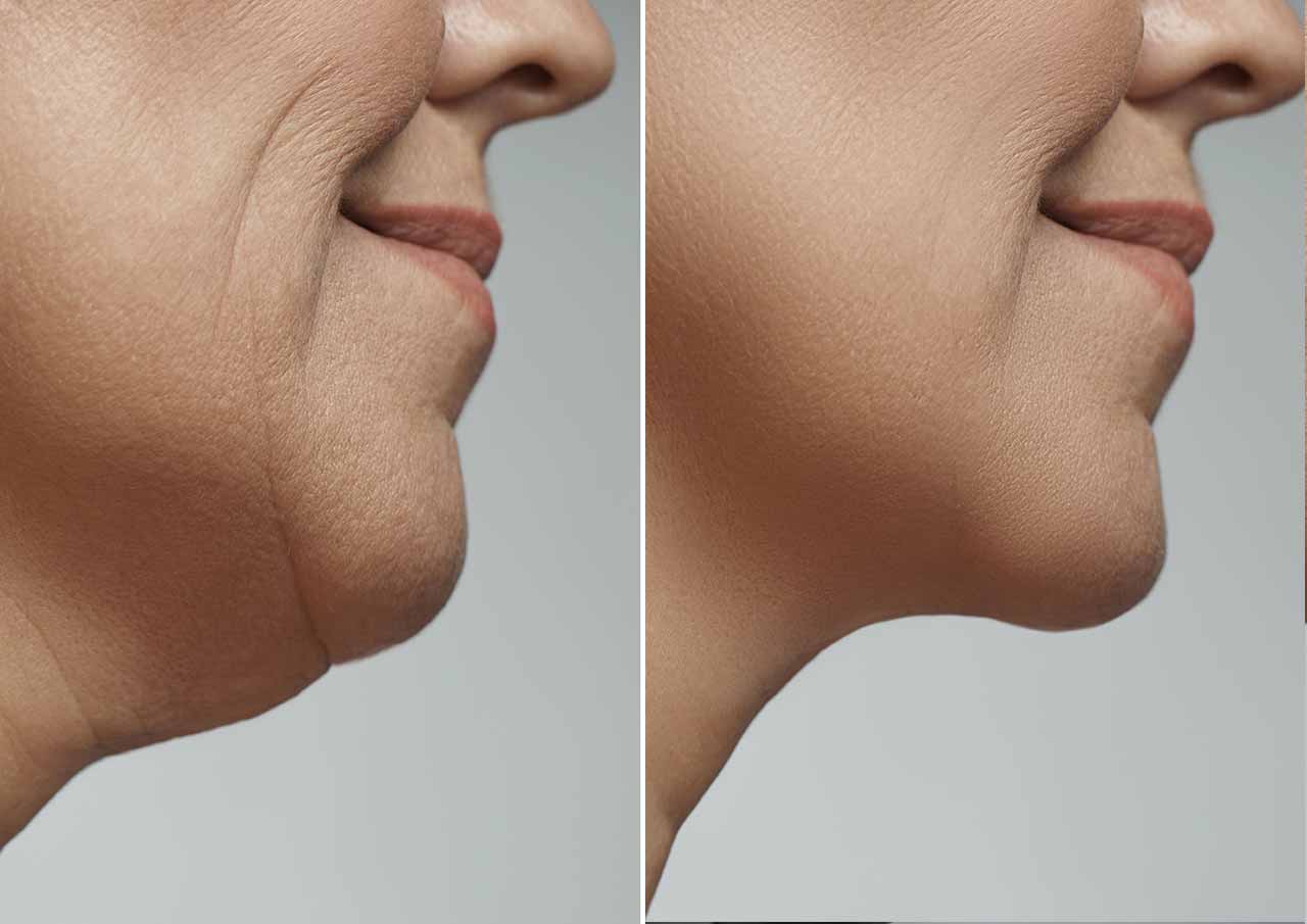 Chin Augmentation 1 More-Defined-Chin-Without-Surgery