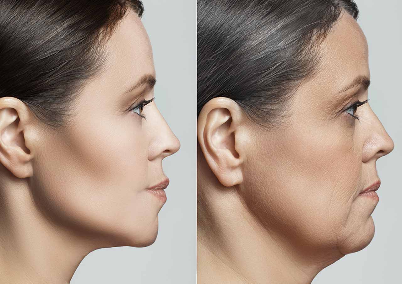 Jawline Contouring 1 More-Sculpted-Jawline-Without-Surgery