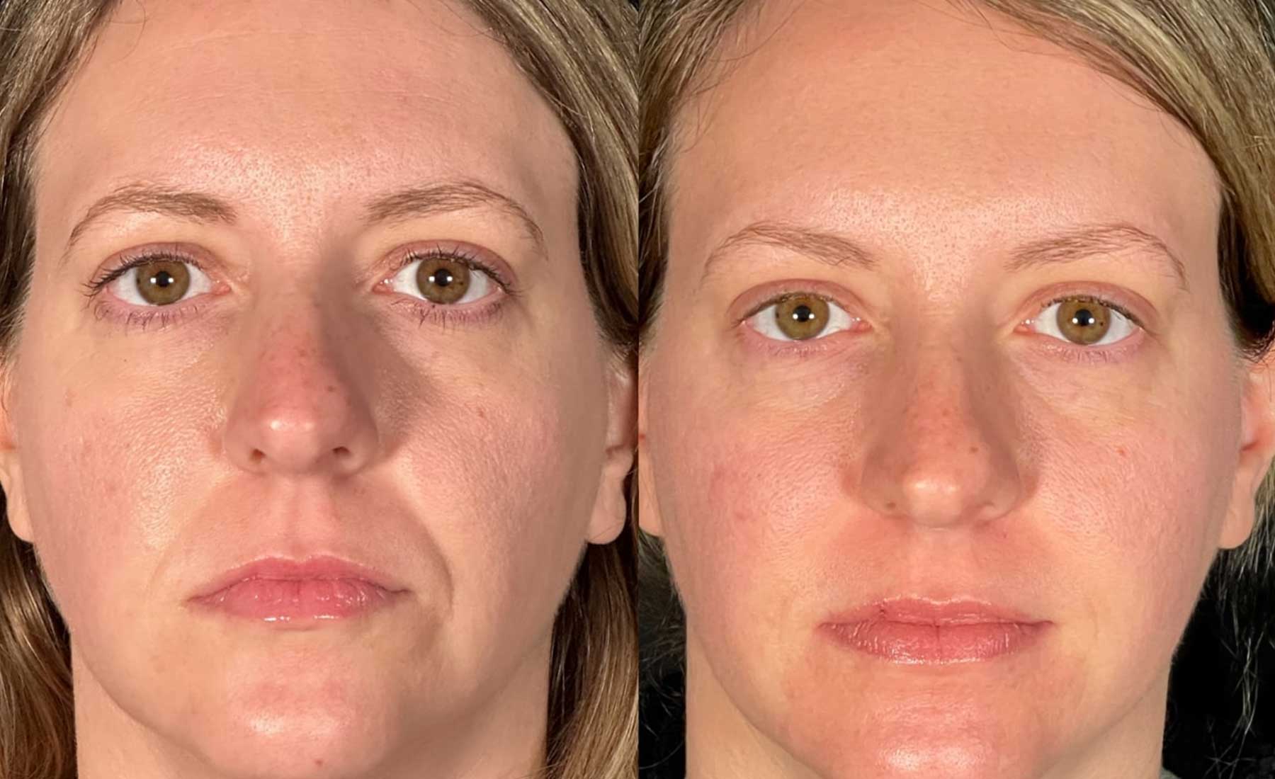 Nasolabial Folds (Smile Lines)