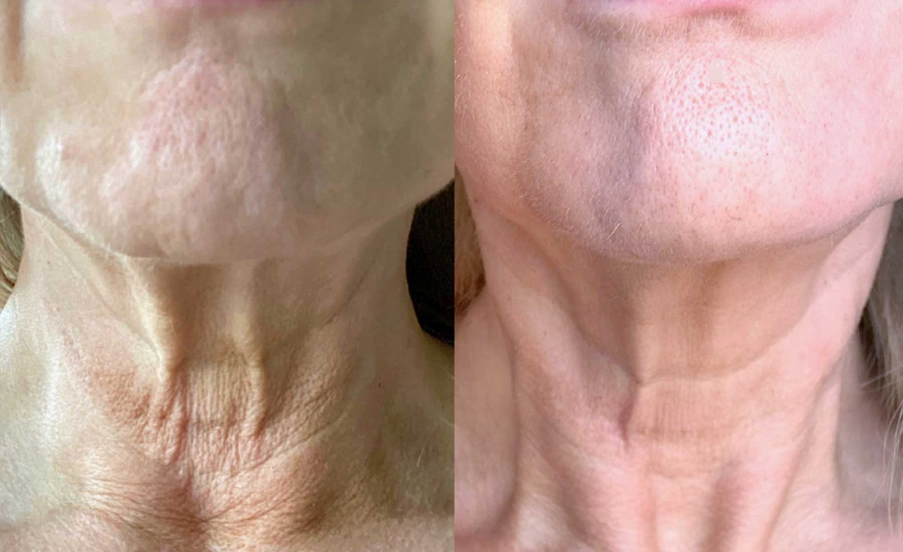 Nefertiti Neck Lift 5 Nefertiti Neck Lift-Before and after