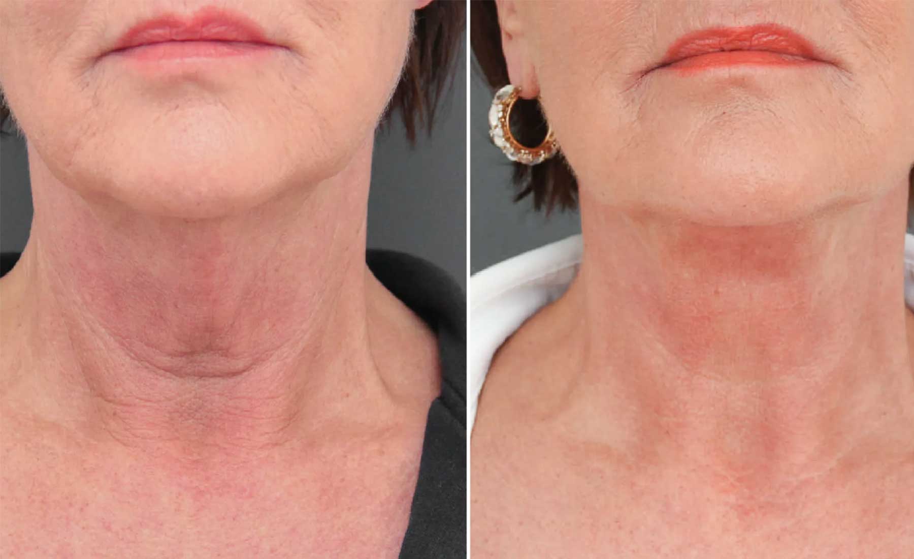 Nefertiti Neck Lift-Before and after