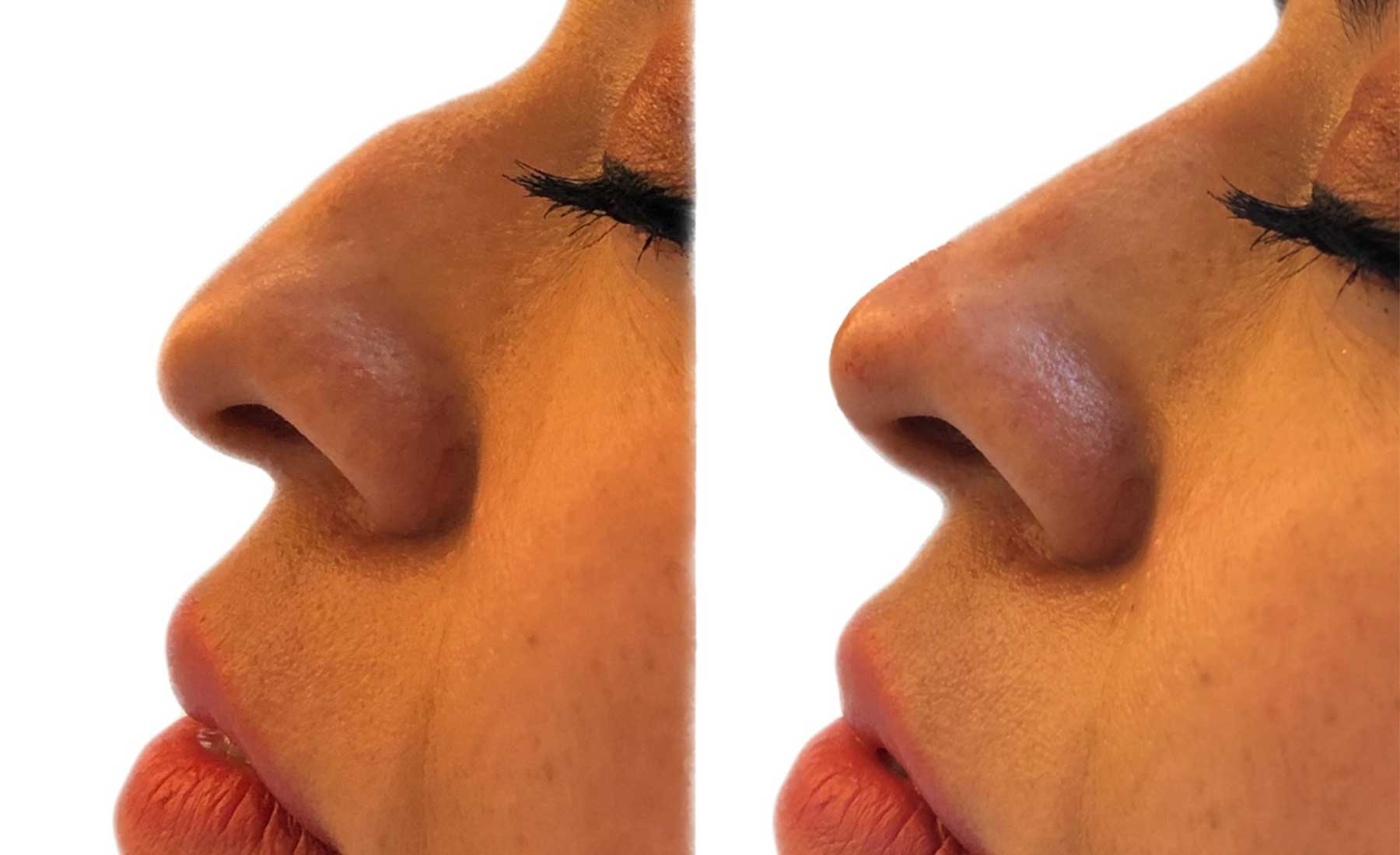 What to Know Before Your First Non-Surgical Nose Job