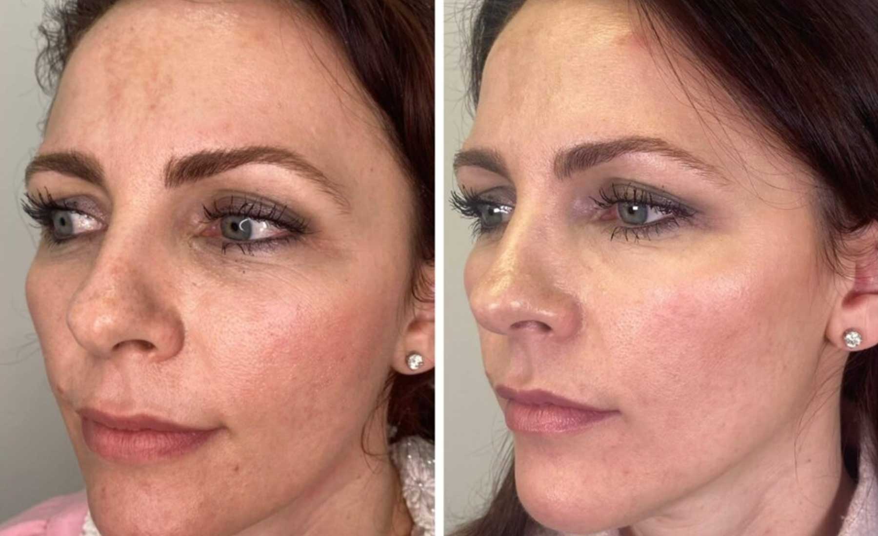 PROFHILO Treatment‎-Before and after