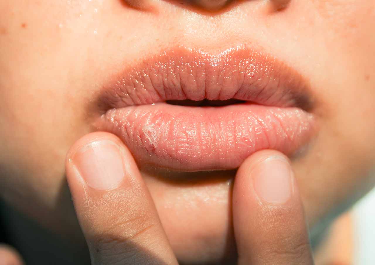 Lip Enhancement 1 Plumper-More-Attractive-Lips-Without-Surgery