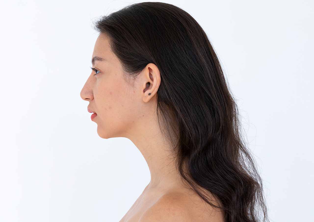Masseter Reduction (Jaw Slimming) 1 Prominent-Jawline