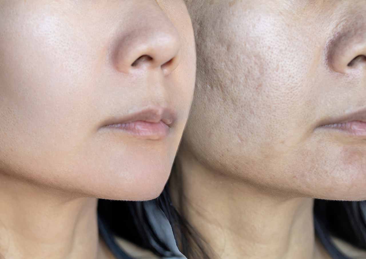 SUNEKOS Treatment 1 sunekos-treatment-Monaz-Clinic