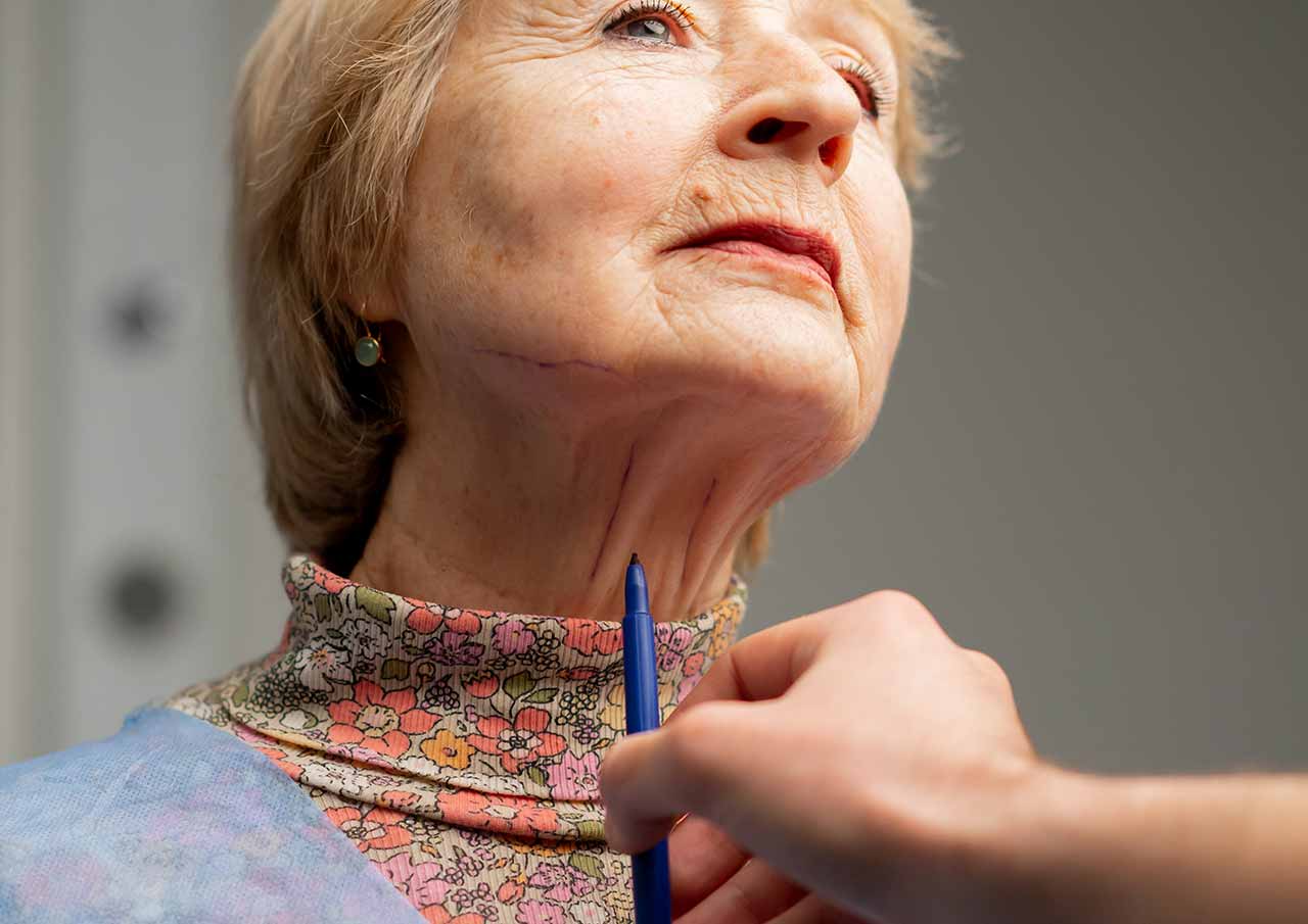 Nefertiti Neck Lift 1 Sagging-Skin-or-Jowls-Affecting-Your-Confidence