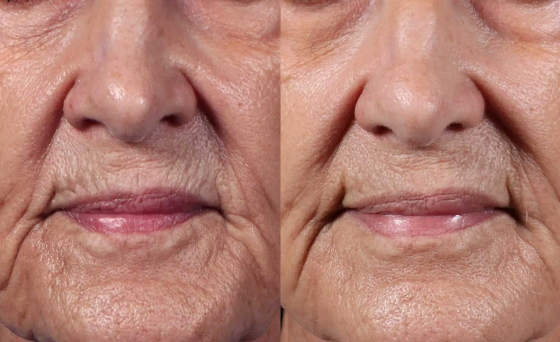 Smokers' Lines (Perioral Lines)‎-Before and after