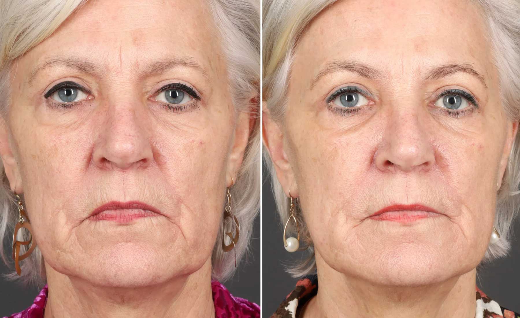 Smokers’ Lines (Perioral Lines)