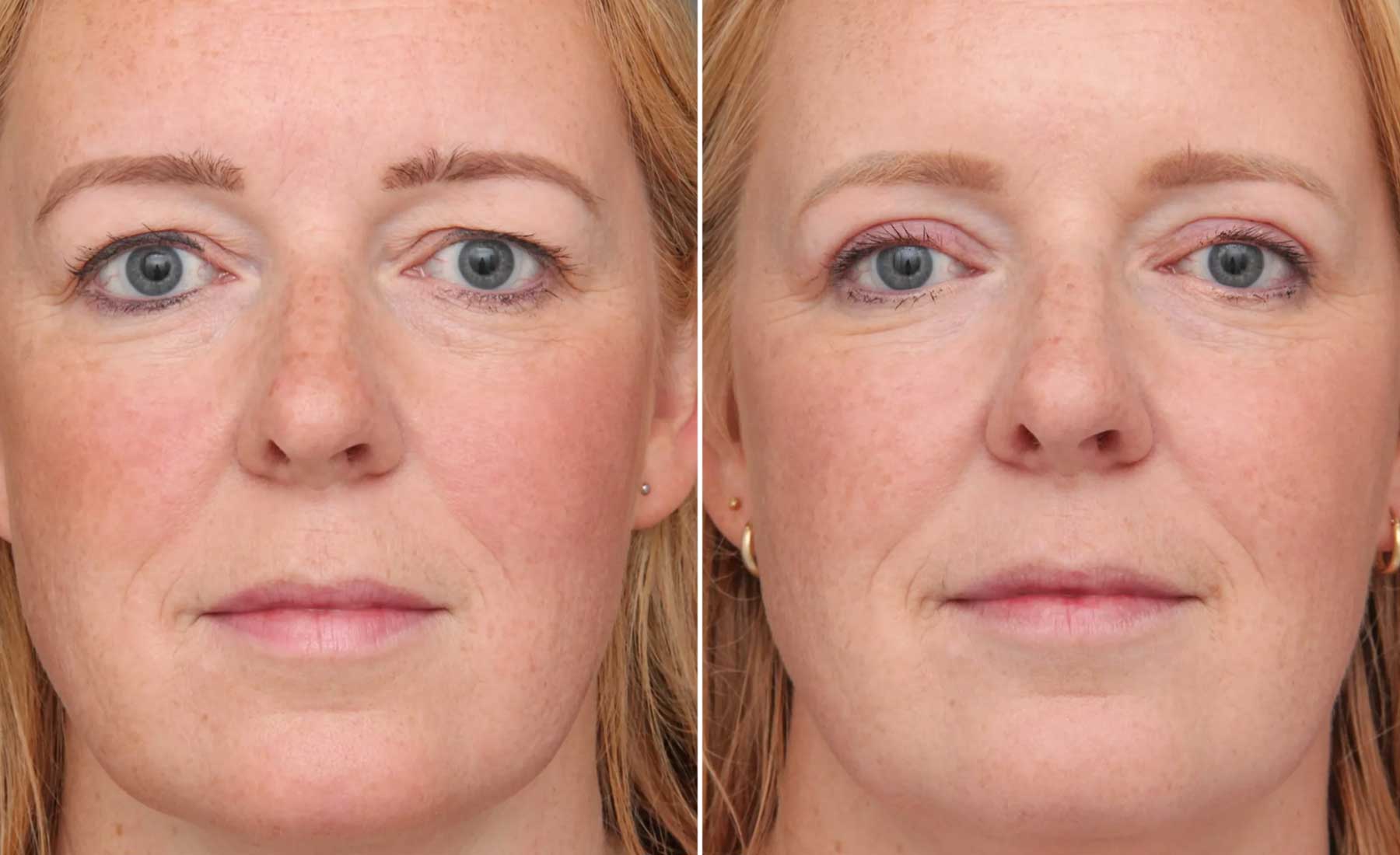 Tear Trough Treatment (Under-Eye Hollows)