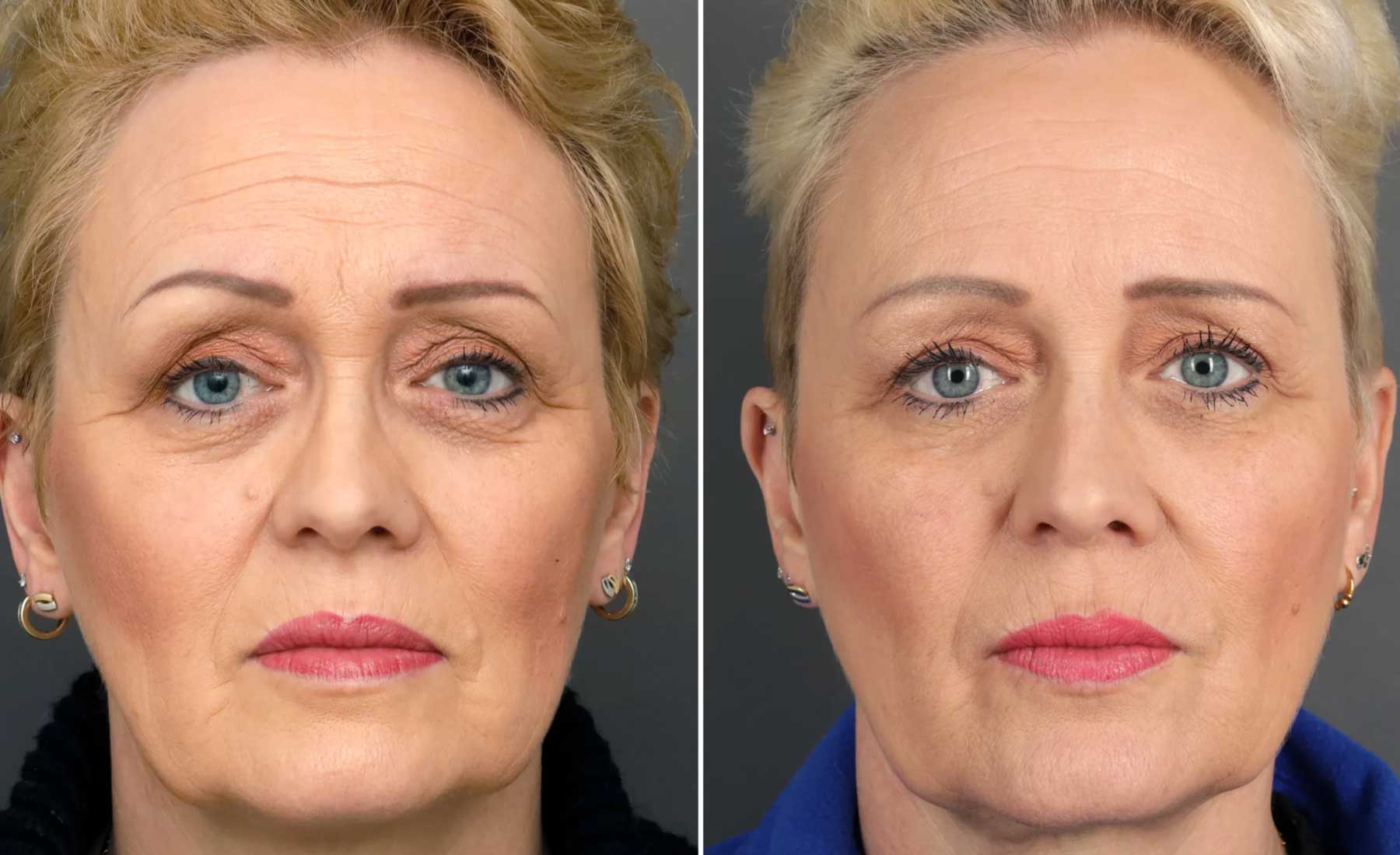 Tear Trough Treatment (Under-Eye Hollows)‎-Before and after