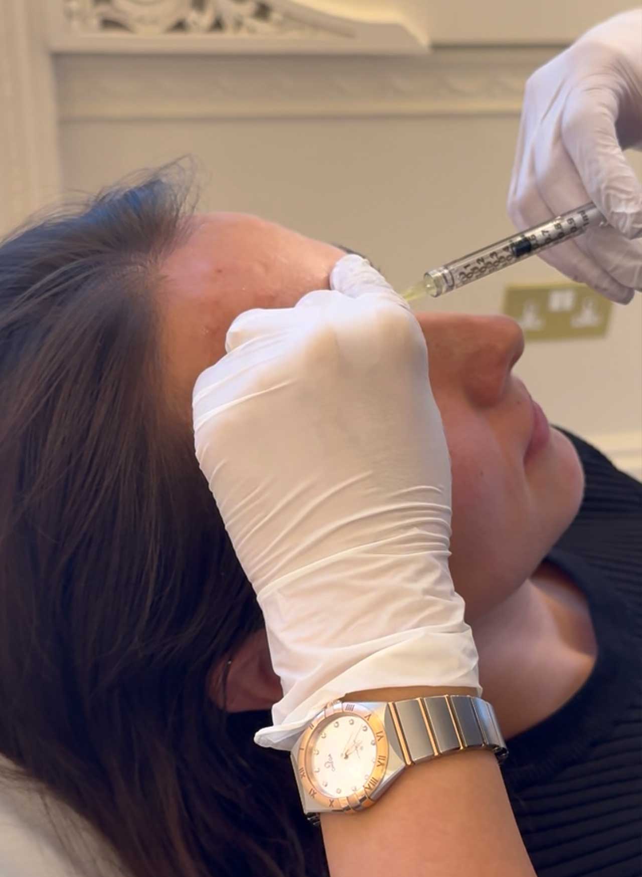 Bunny Lines (Nose Wrinkles) 3 Specialist injecting anti-wrinkle treatment into the upper nose area for bunny lines at Monaz Clinic