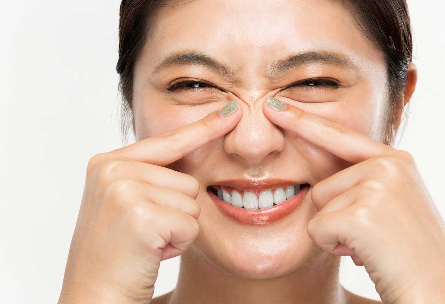 Bunny Lines (Nose Wrinkles) 2 Woman demonstrating bunny lines (nose wrinkles) while smiling, suitable candidate for anti-wrinkle injections