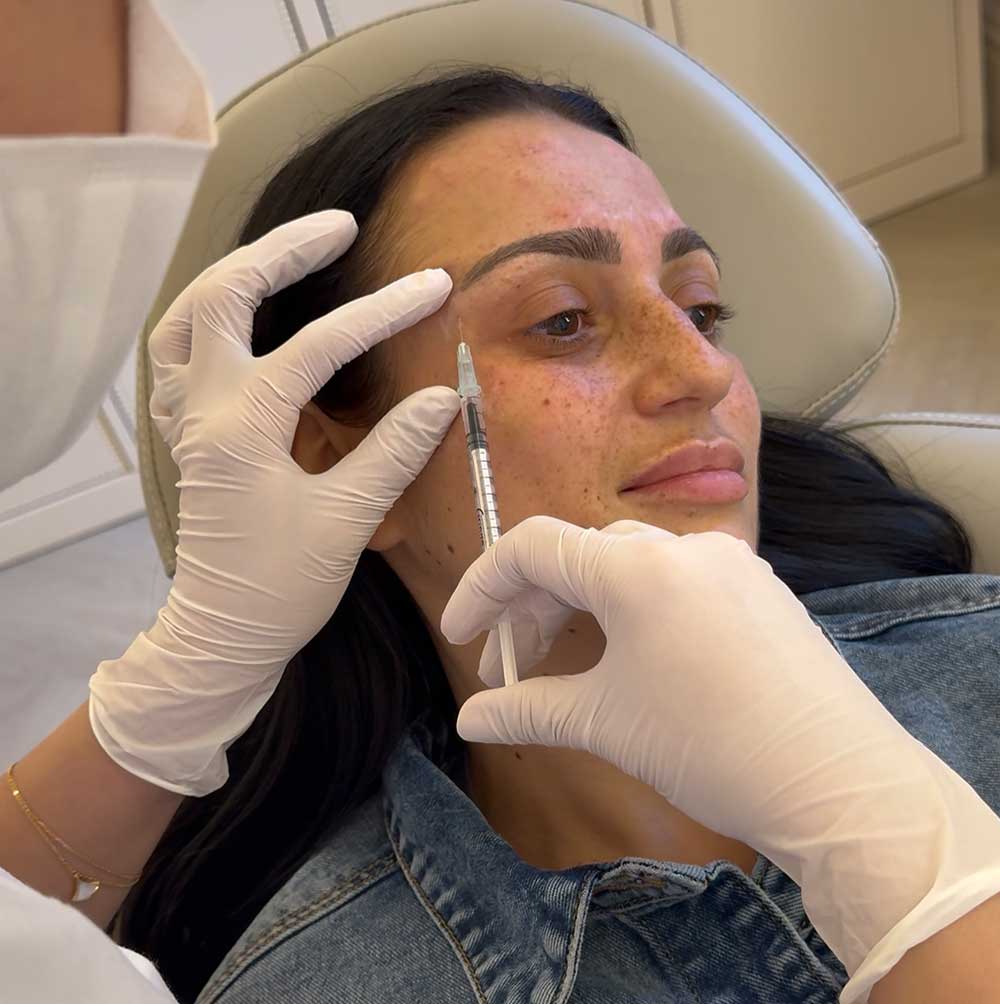 Brow Lift 1 Anti-wrinkle injections being administered to lift drooping brows and reduce tired appearance around the eyes.