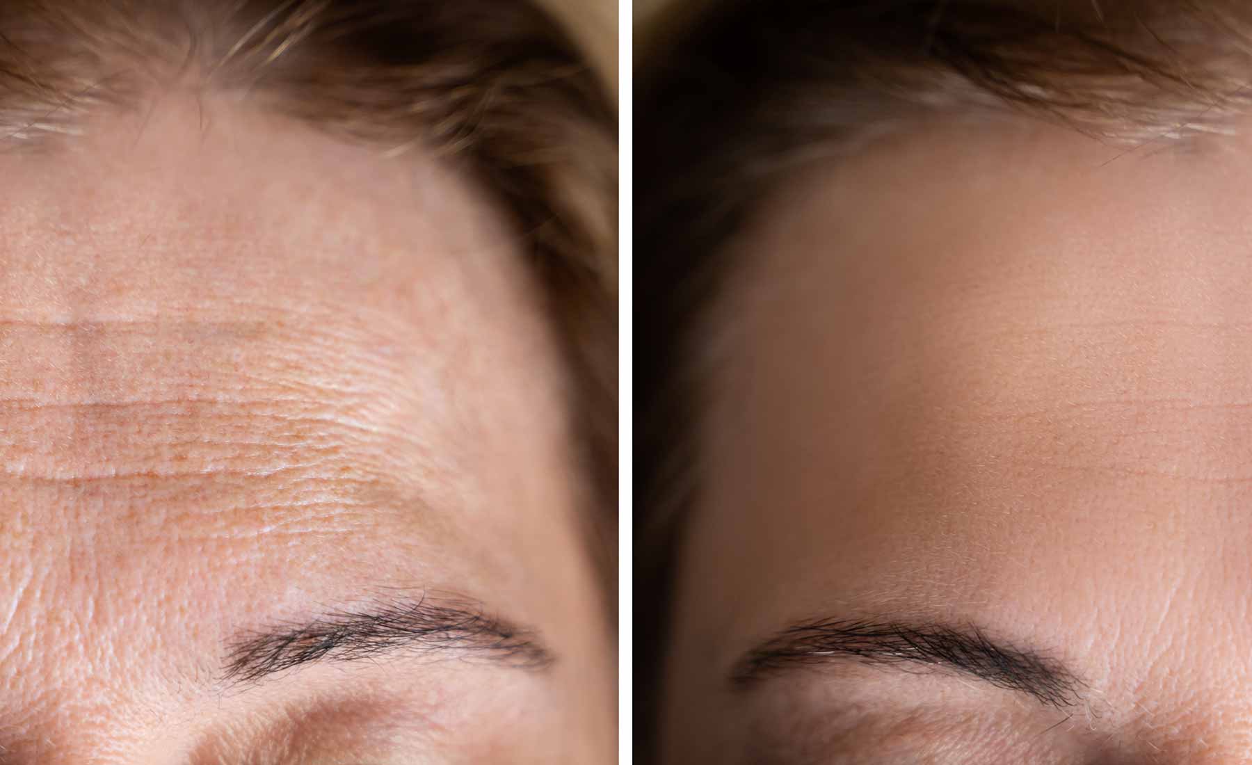 Forehead Lines 3 forehead-lines-before-after-3