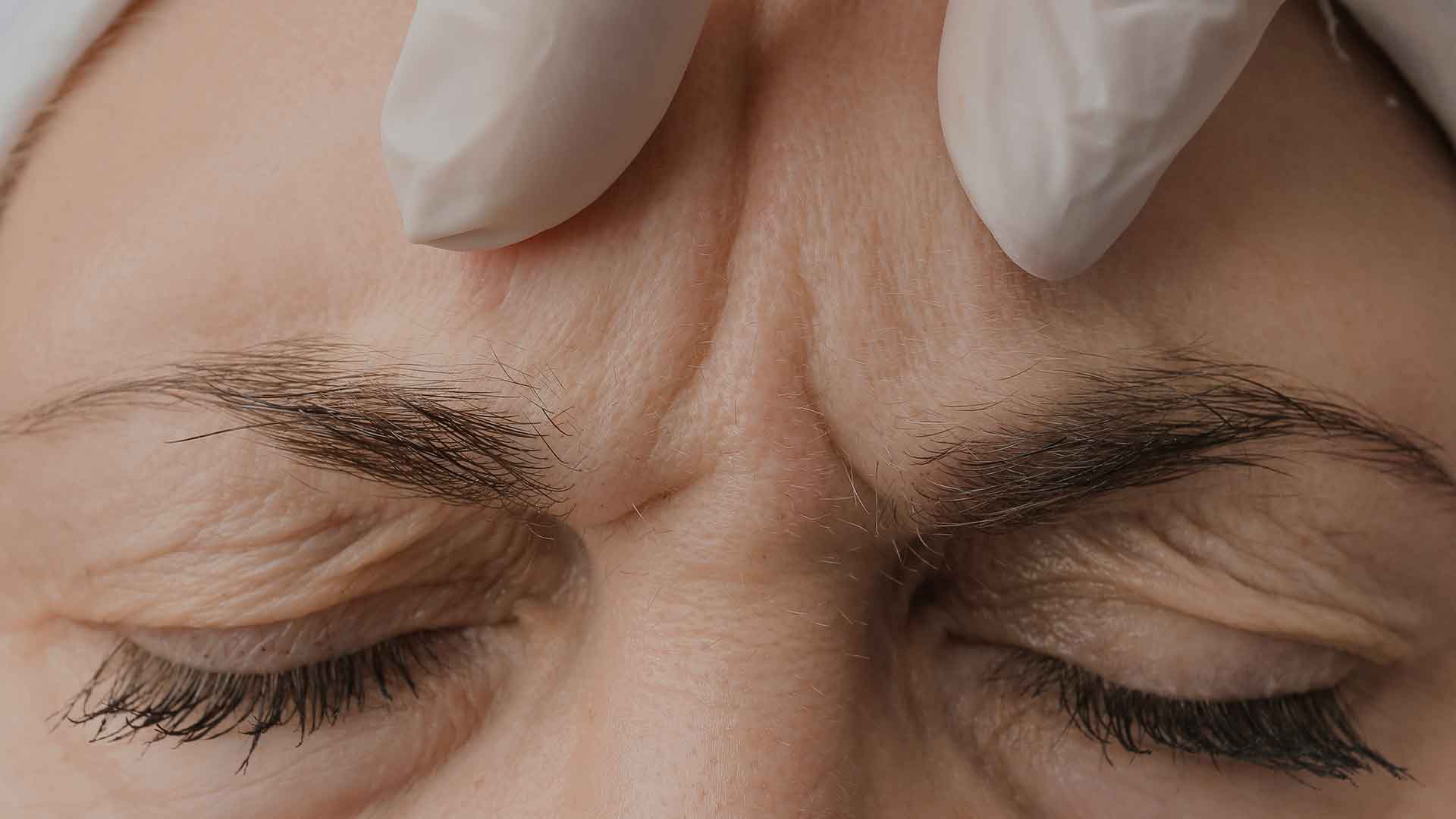 frown-lines-monaz-clinic