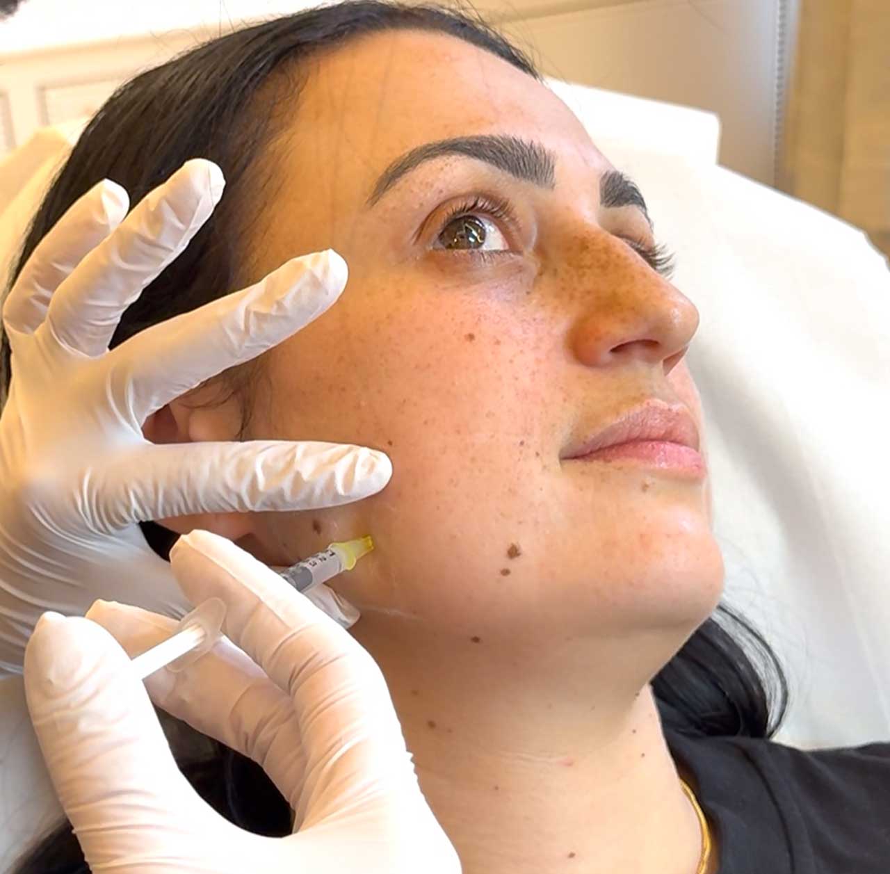 Anti-Wrinkle Injection being administered into the masseter muscle to treat Teeth Grinding and Jaw Clenching (Bruxism) at Monaz Clinic.