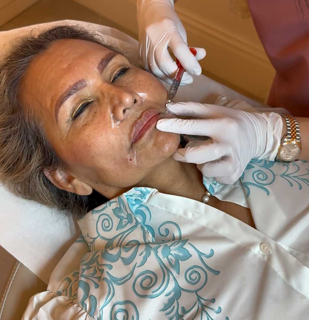 Practitioner performing anti-wrinkle injection treatment to correct downturned mouth corners and marionette lines at Monaz Clinic.