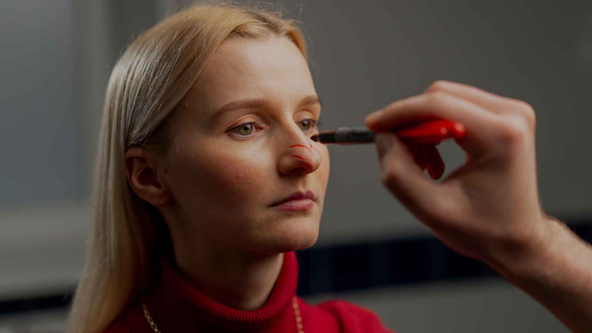 Bunny Lines (Nose Wrinkles) 1 nose-wrinkles-monaz-clinic