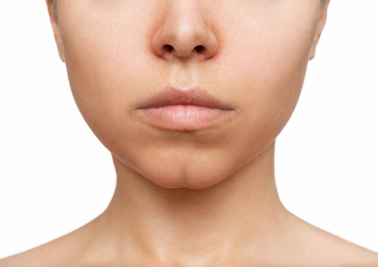Chin Dimples and Pebbling 2 who-is-chin-dimples-treatment-for