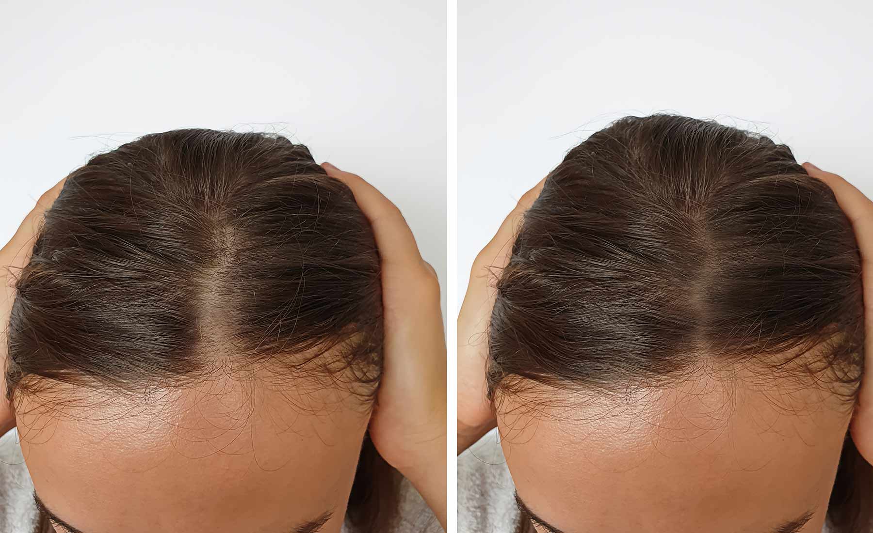 Dr.-CYJ-Hair-Filler-Before-and-after-2