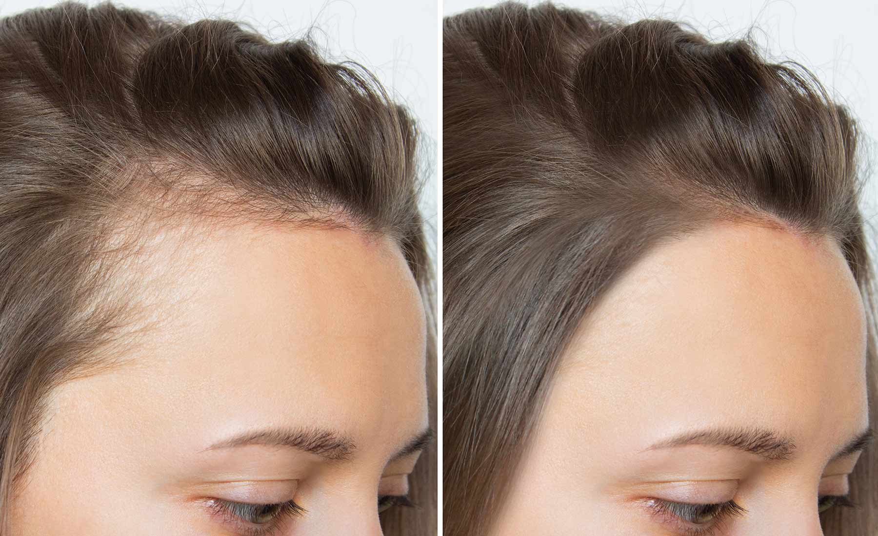 PLINEST-Hair-treatment-Before-after-2