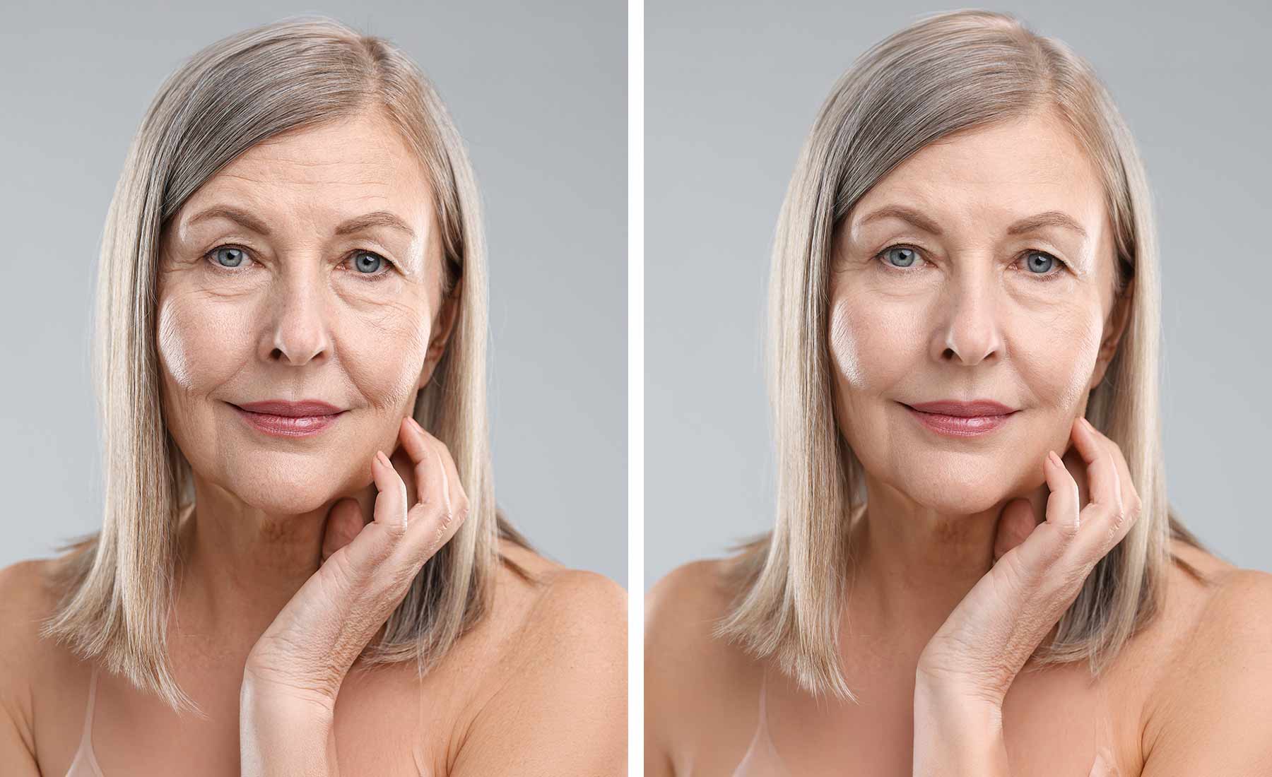 Dermapen Anti-Ageing Treatment 3 Dermapen Anti Ageing Treatment before after 1 1