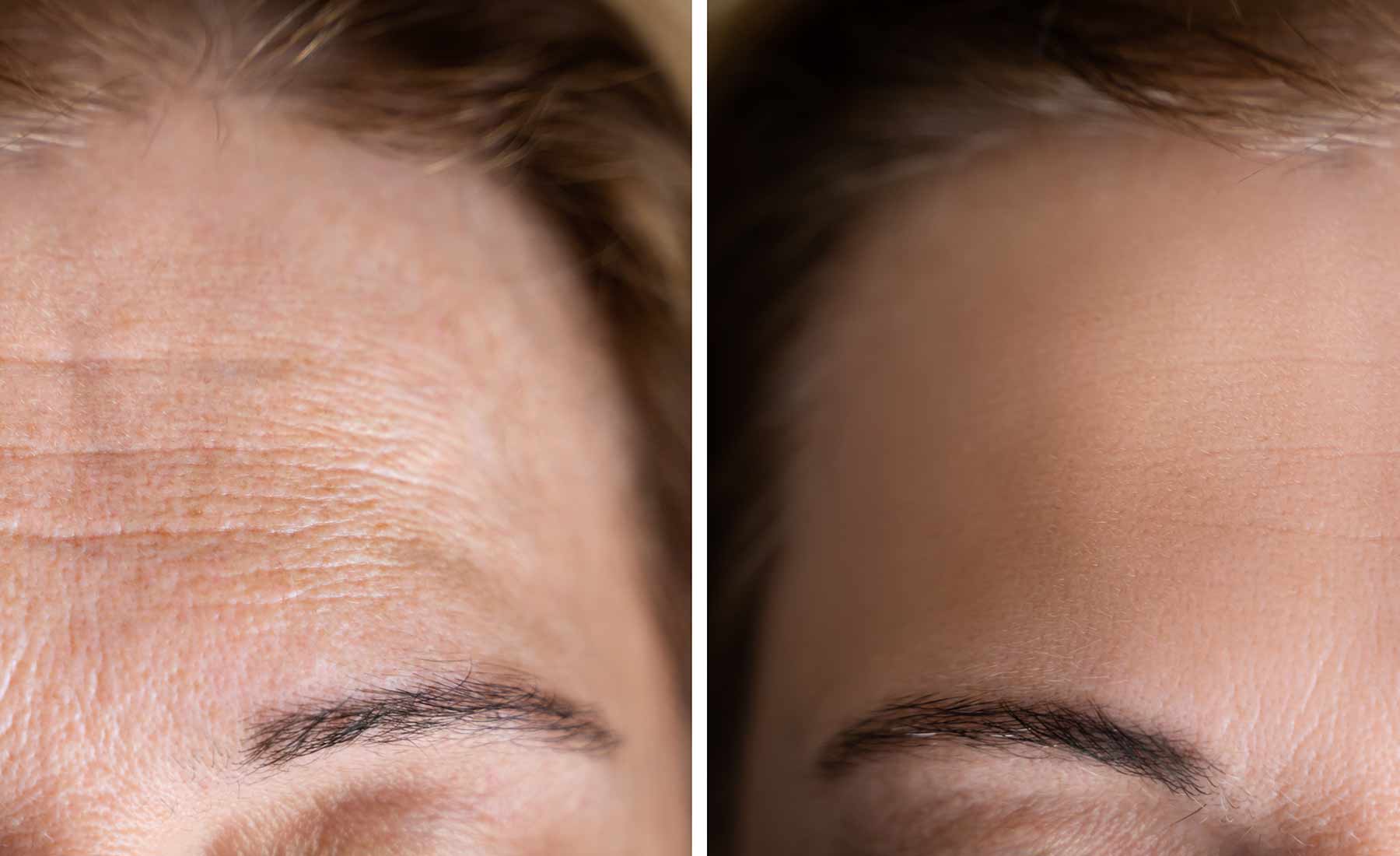 Dermapen Anti-Ageing Treatment 4 Dermapen Anti Ageing Treatment before after 2