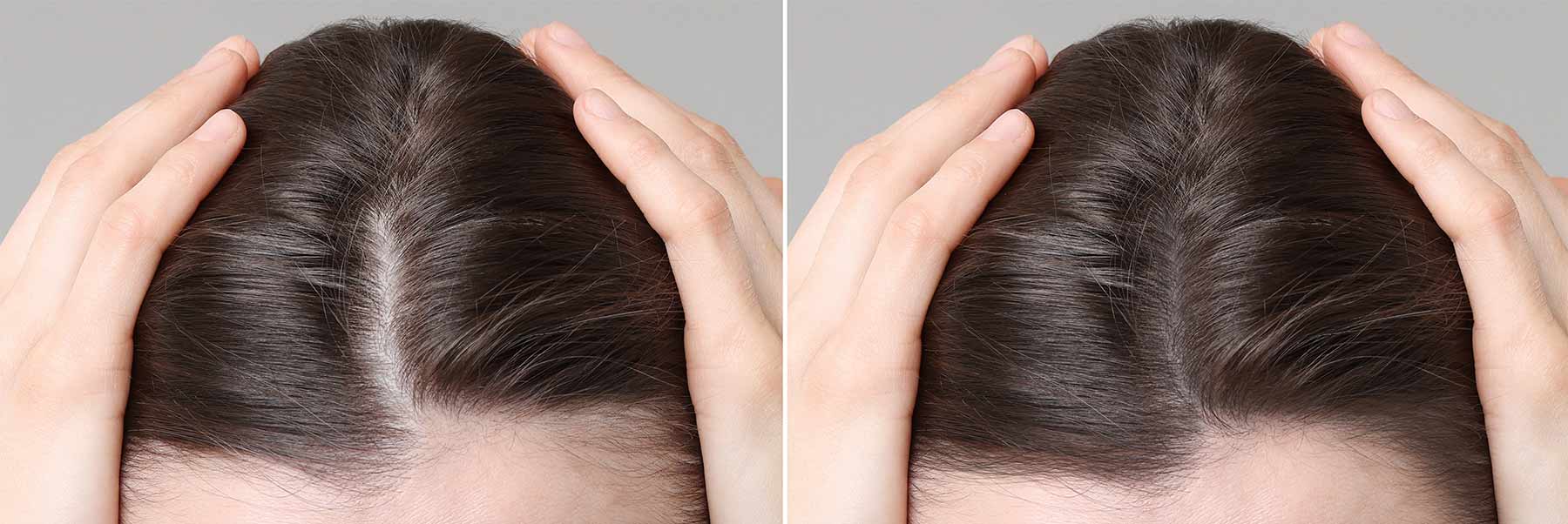 Dermapen + Exosome Treatment for Hair and Scalp Rejuvenation 3 Dermapen Exosome Treatment for Hair and Scalp Rejuvenation before and after 1