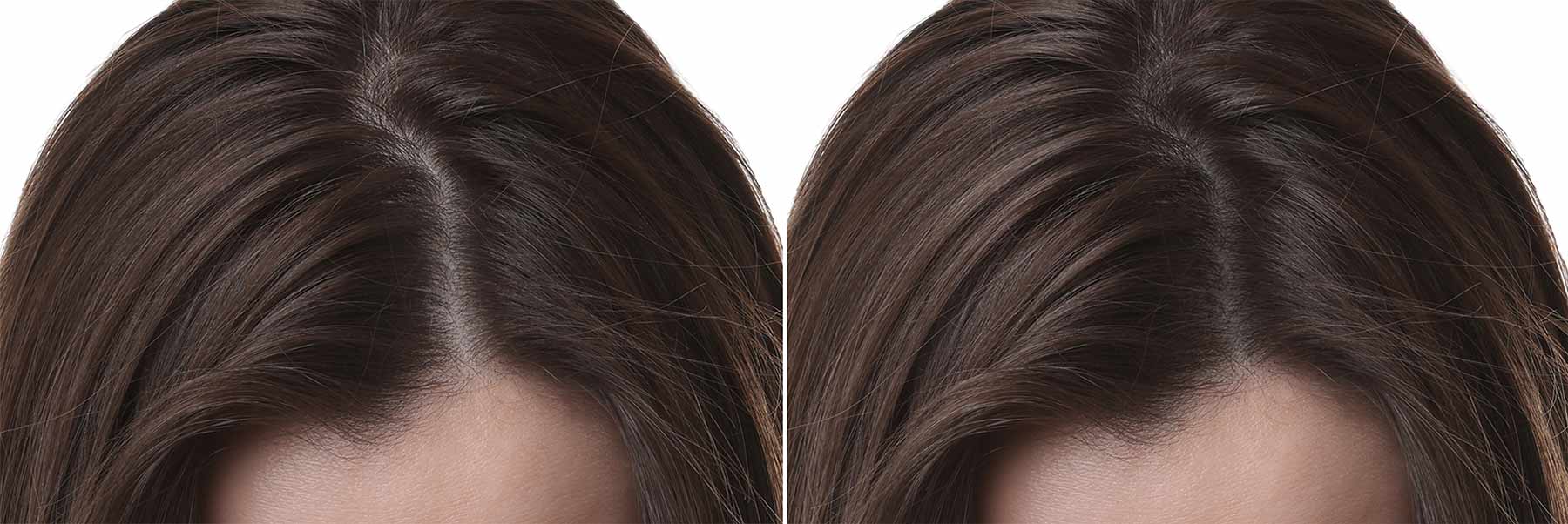 Dermapen + Exosome Treatment for Hair and Scalp Rejuvenation 4 Dermapen Exosome Treatment for Hair and Scalp Rejuvenation before and after 2