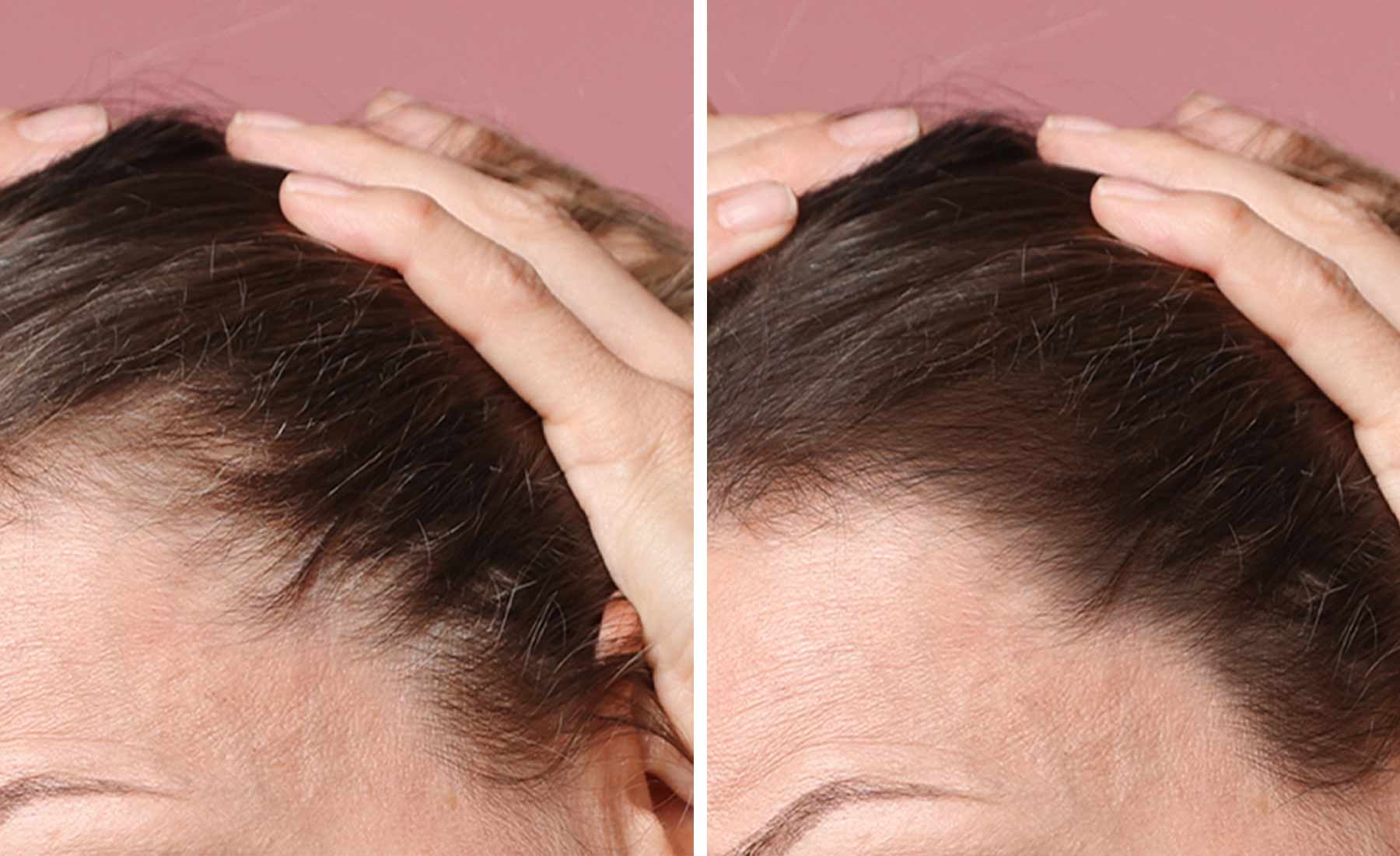 Dermapen Hair Loss Treatment before and after 2